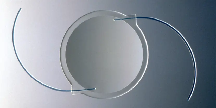 An intraocular lens implant used to replace a cloudy lens after cataract surgery