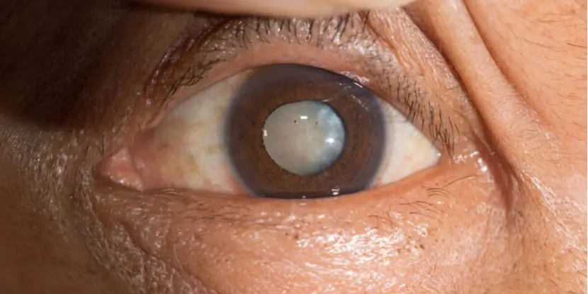 Closeup of an eye with a cloudy lens caused by a cataract