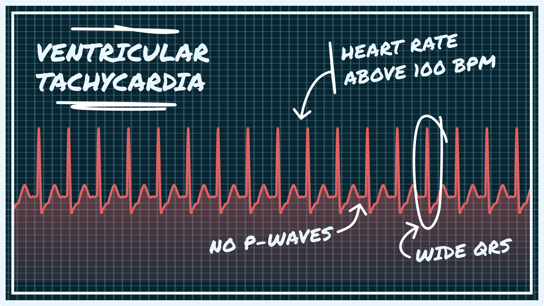 Ventricular Tachycardia Overview