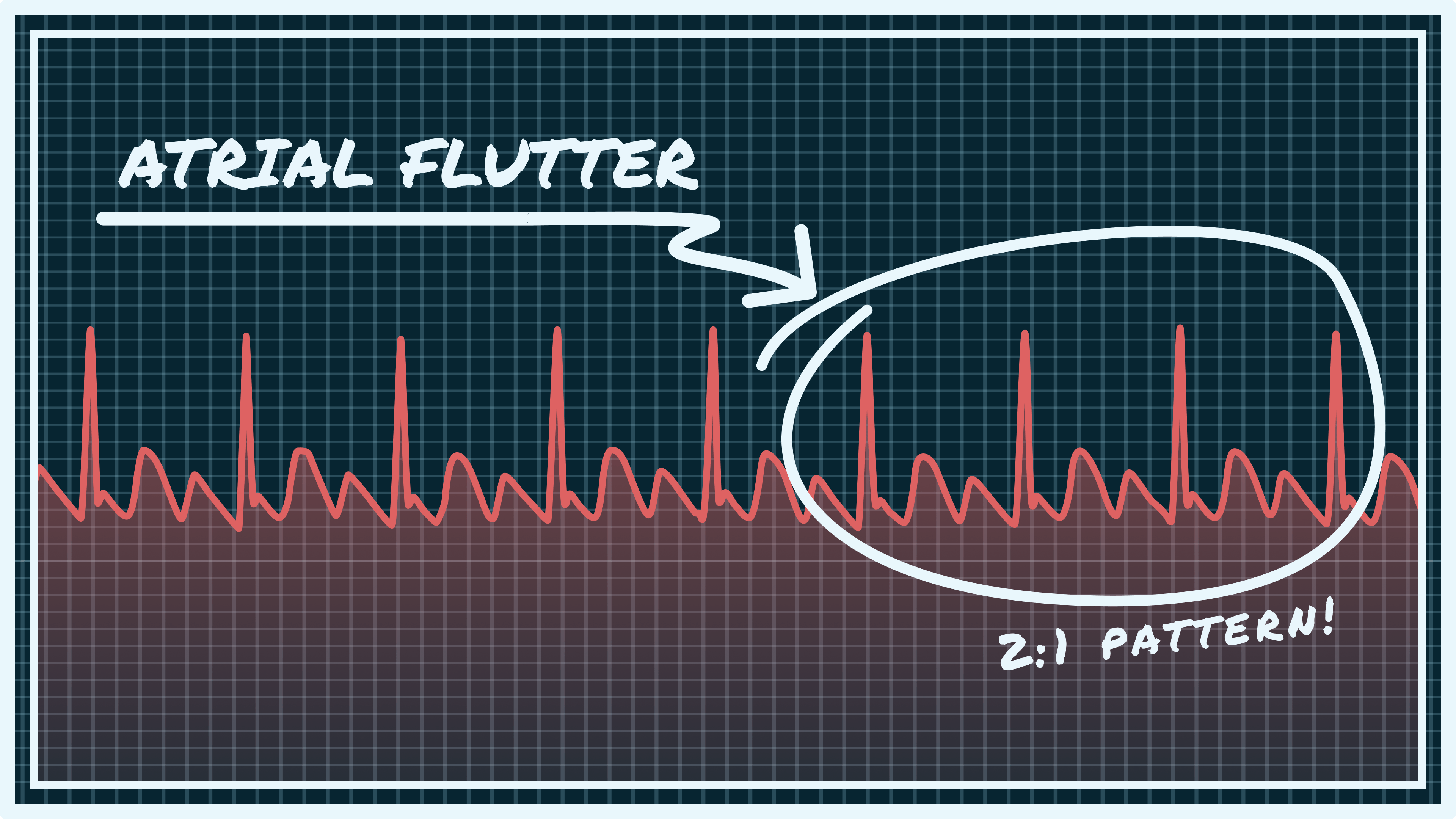 Left Side Flutter:  Could It Be Your Heart? (Find Out Now!) - adqxn9s