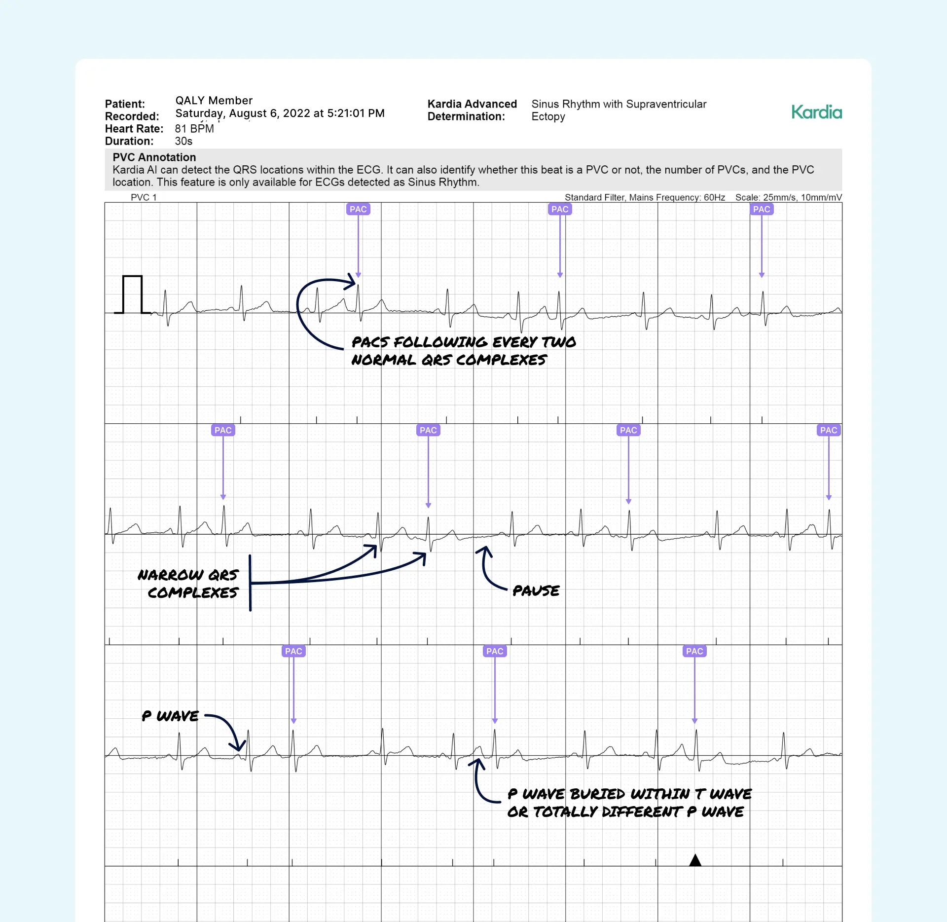 Irregular Heartbeat?  Bigeminy Or Trigeminy   Which Requires Urgent Care? - rbwaukw
