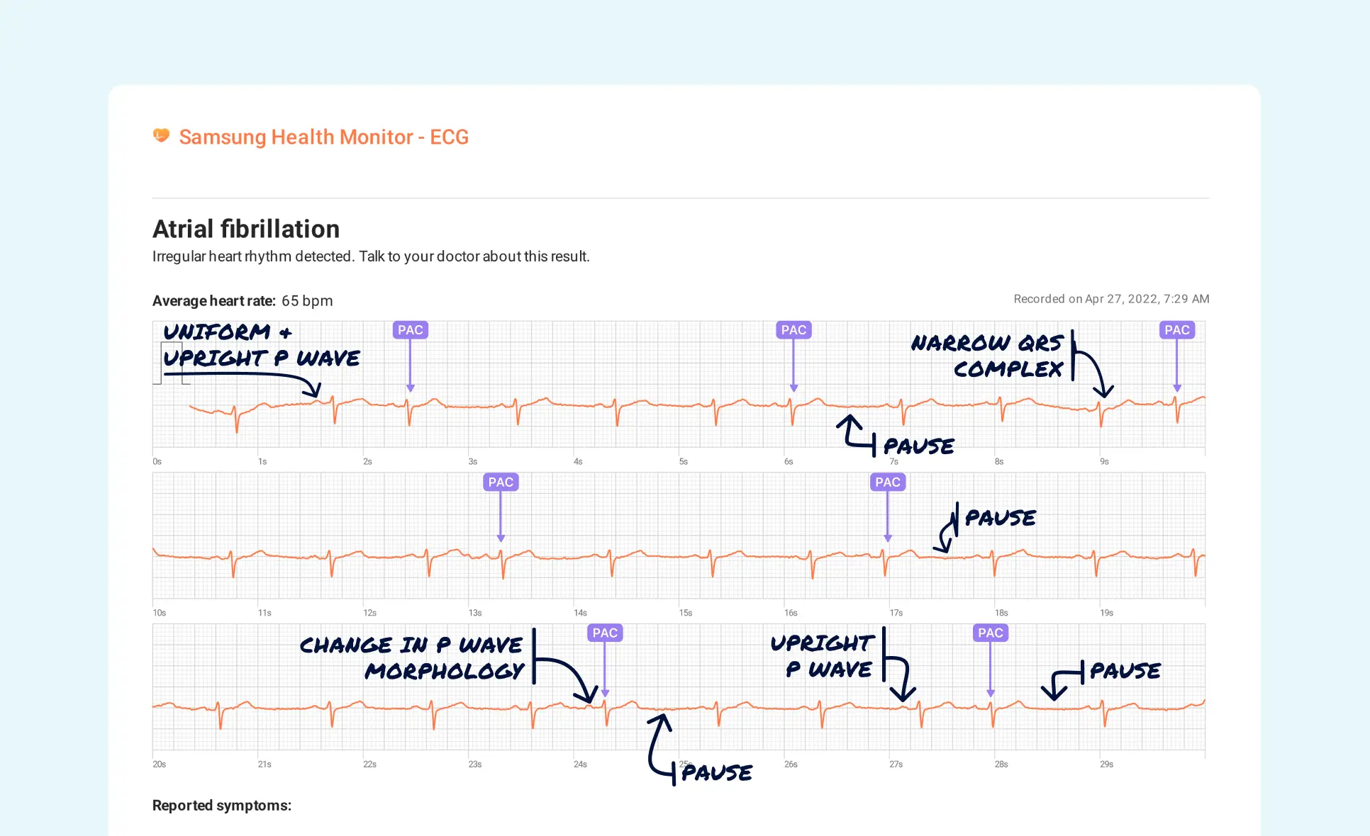 Sinus Arrhythmia Vs. Premature Atrial Contraction (Multiple) on Your ...