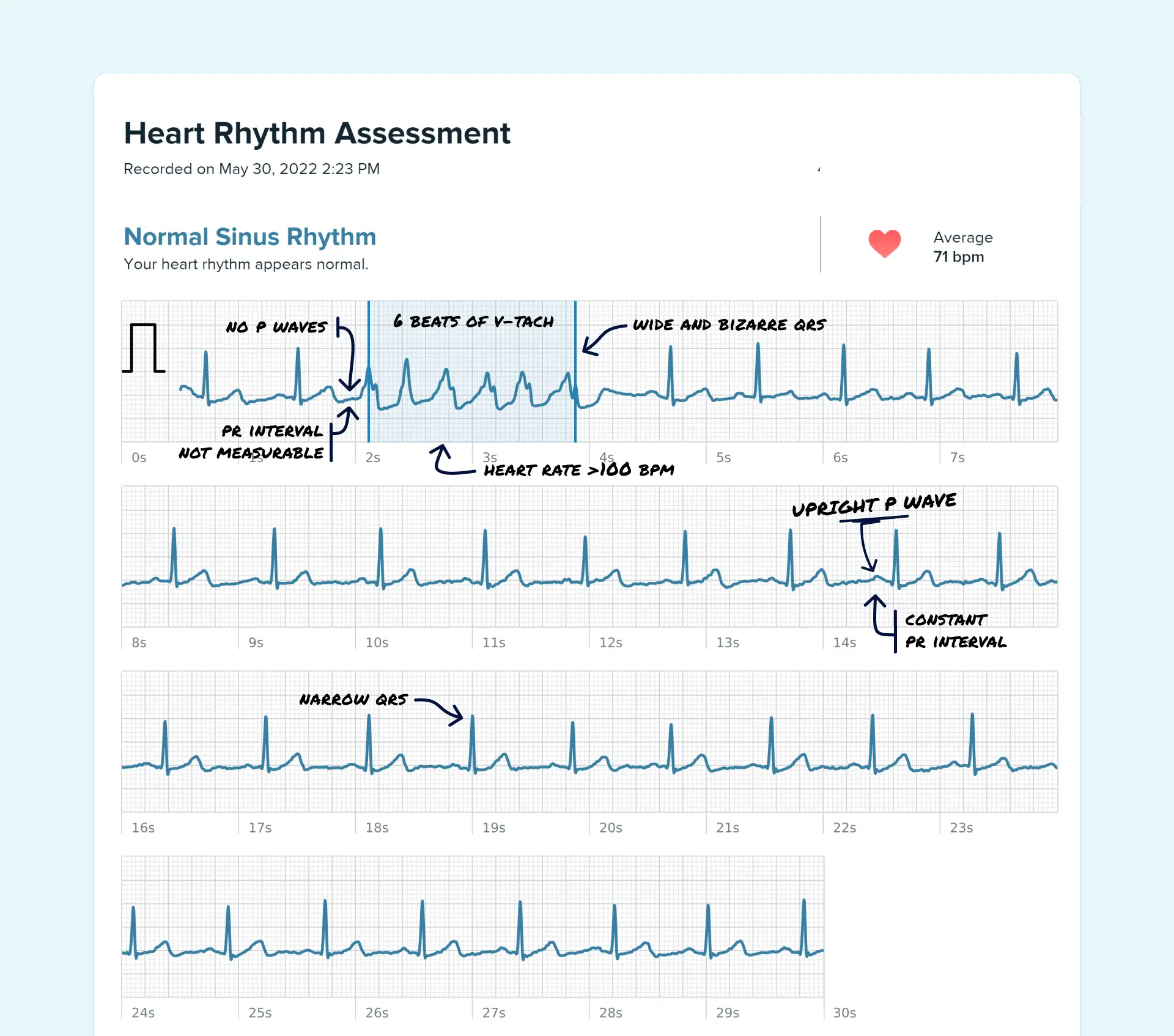 Idioventricular Rhythm Vs Junctional