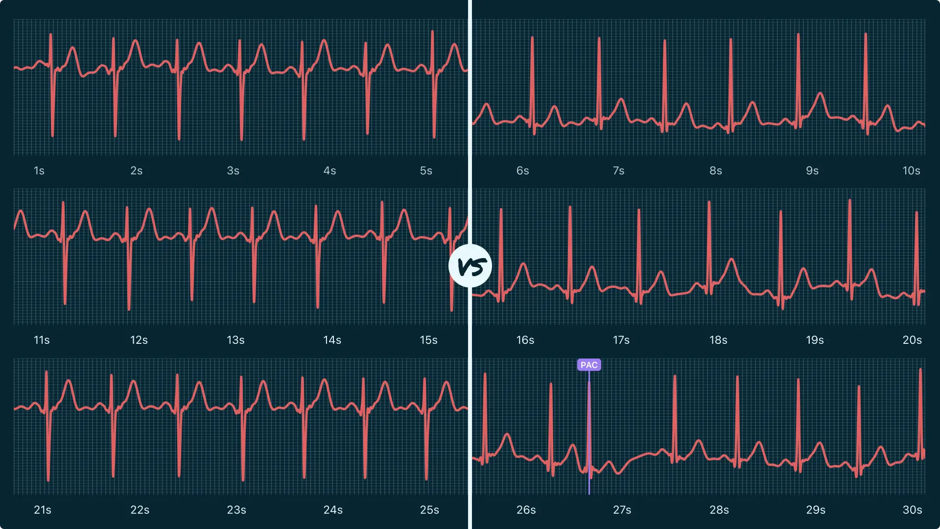 Sinus Rhythm Vs. Premature Atrial Contraction (Single) on Your Watch ...