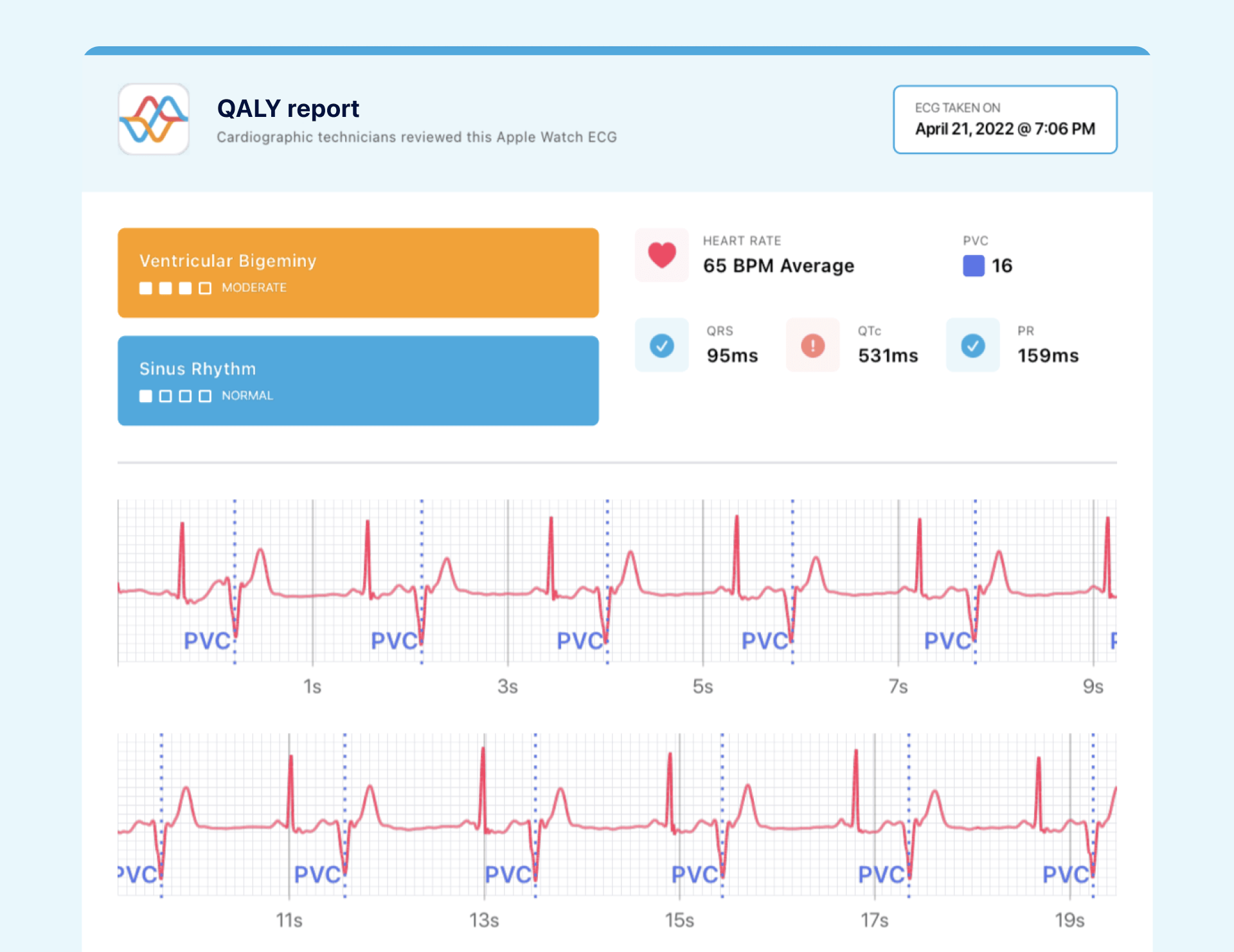 prolonged QTc Interval caught on a Qaly member's Apple Watch ECG