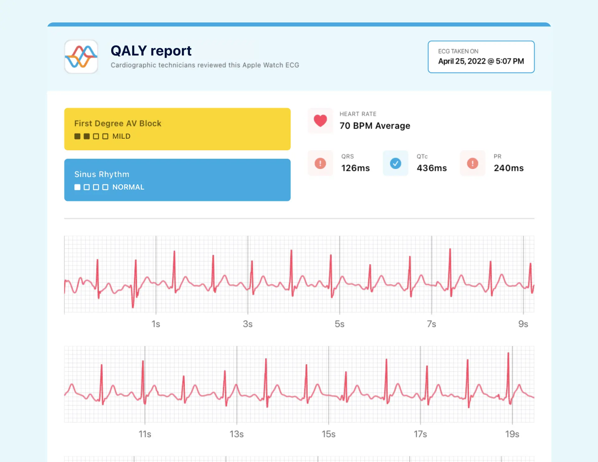 Example of prolonged PR Interval