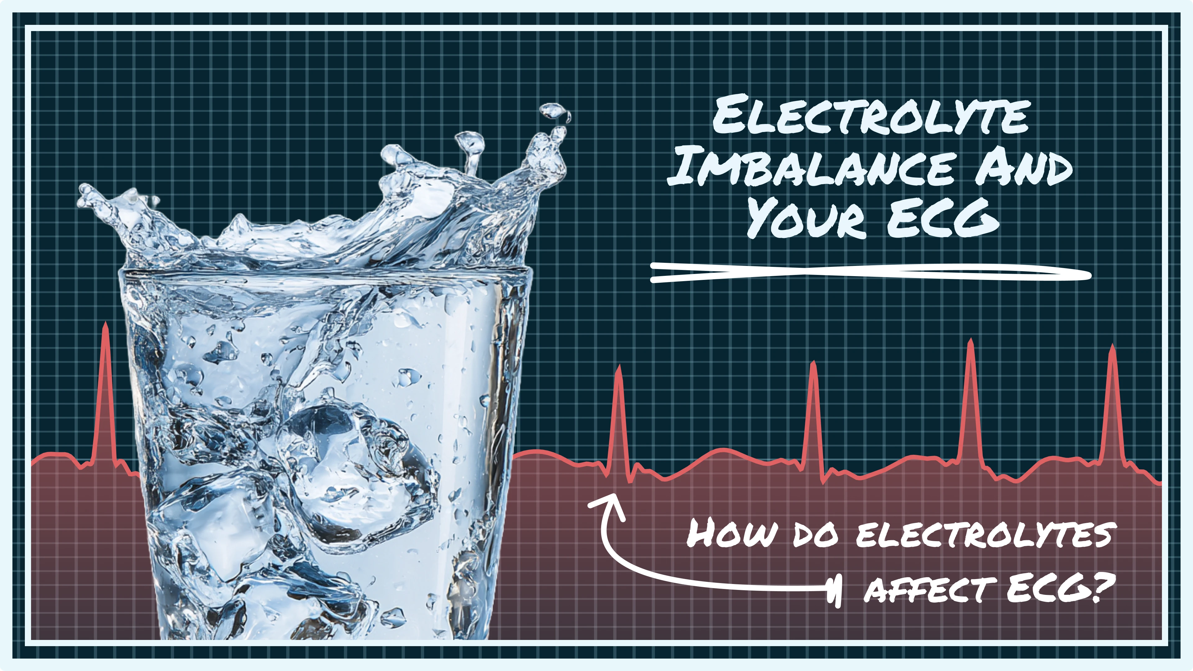 ECG waveform showing electrolyte imbalance patterns on ECG read by Qaly team