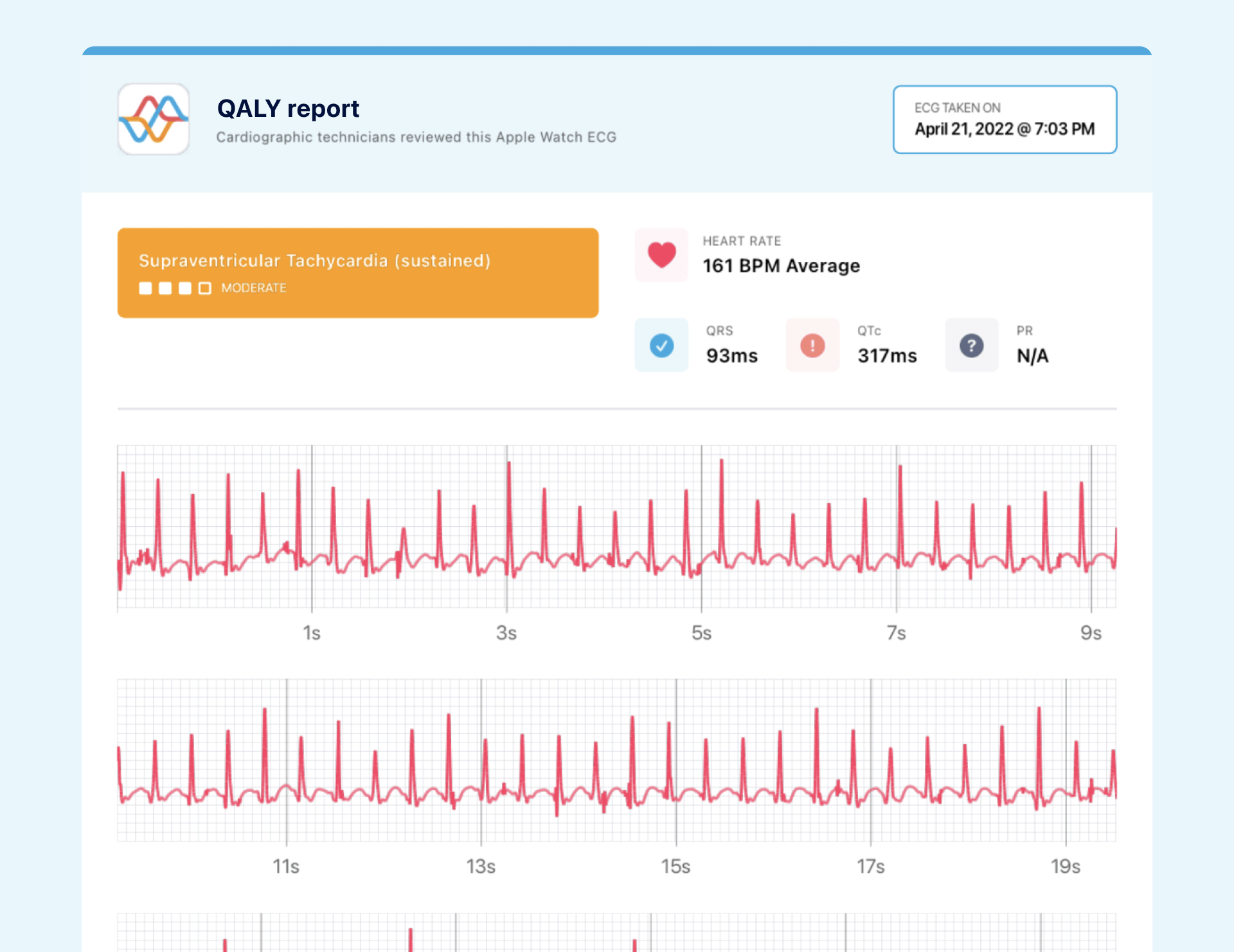 example of short QT interval from apple watch