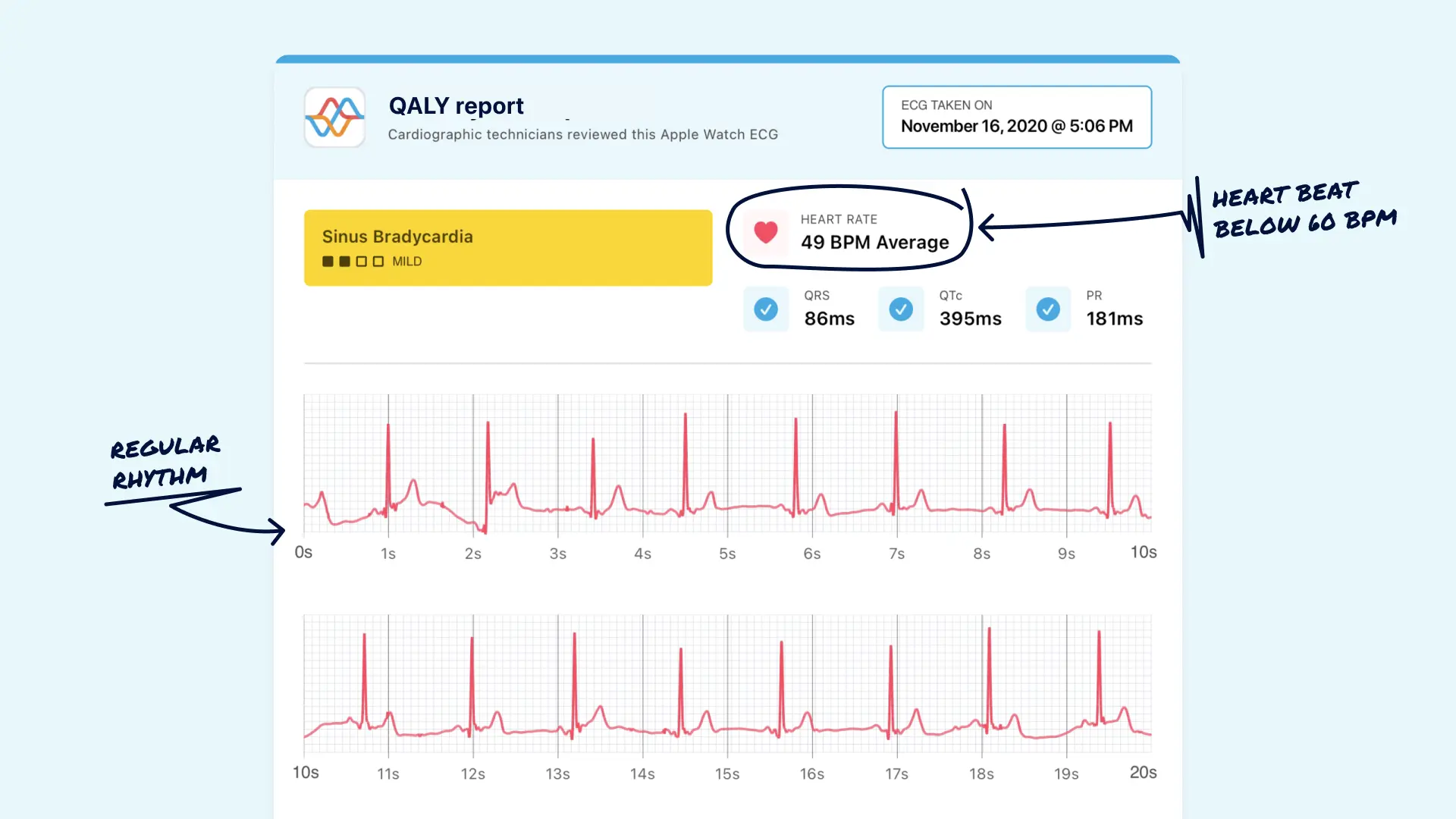 Example of Sinus Bradycardia recorded on Apple Watch and reviewed by Qaly team.