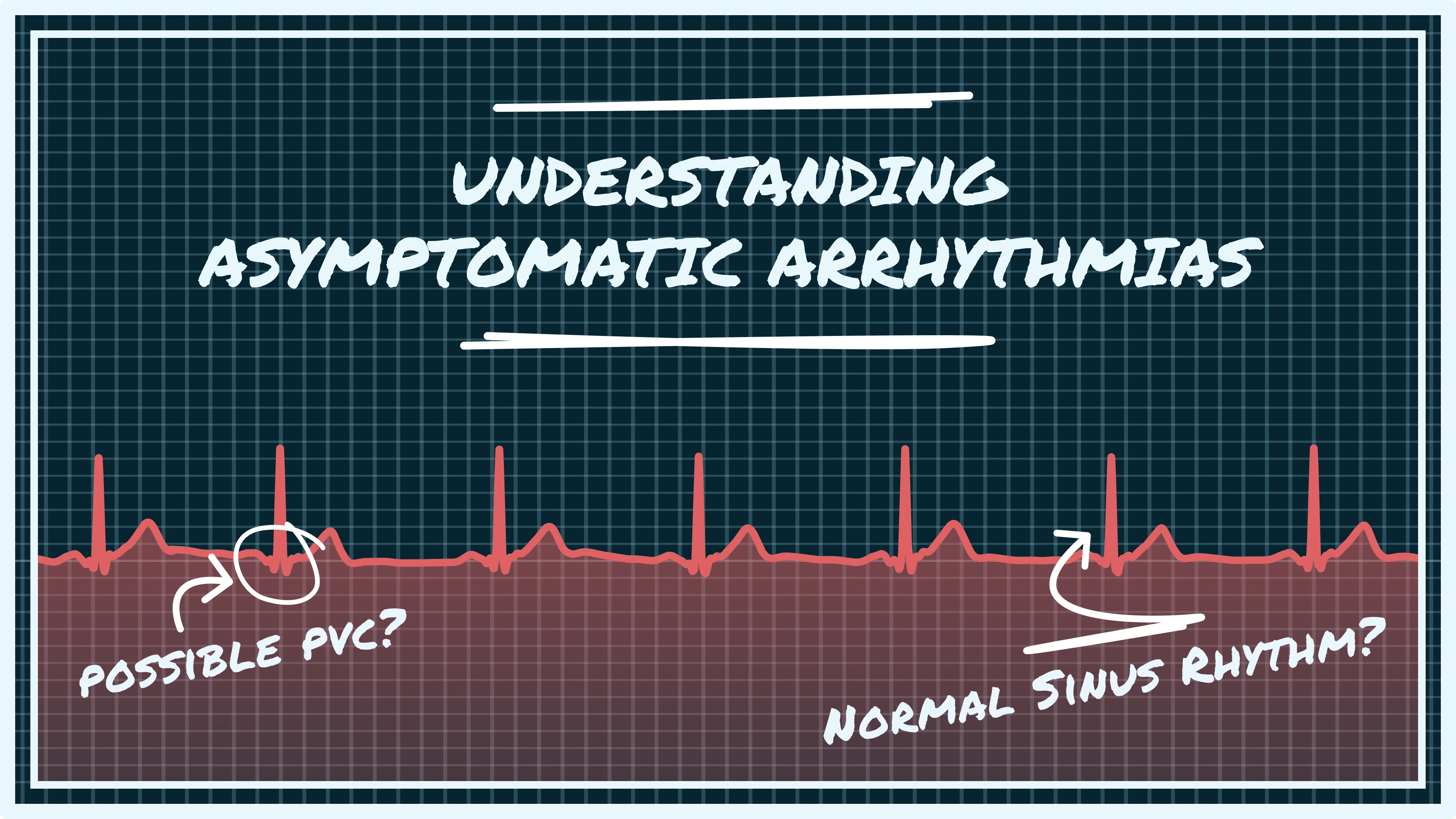 asymptomatic arrhythmias, silent AFib, ECG without symptoms, wearable ECG detection, incidental arrhythmia, PACs PVCs, premature contractions, smartwatch arrhythmia detection, hidden heart rhythms, subclinical arrhythmias