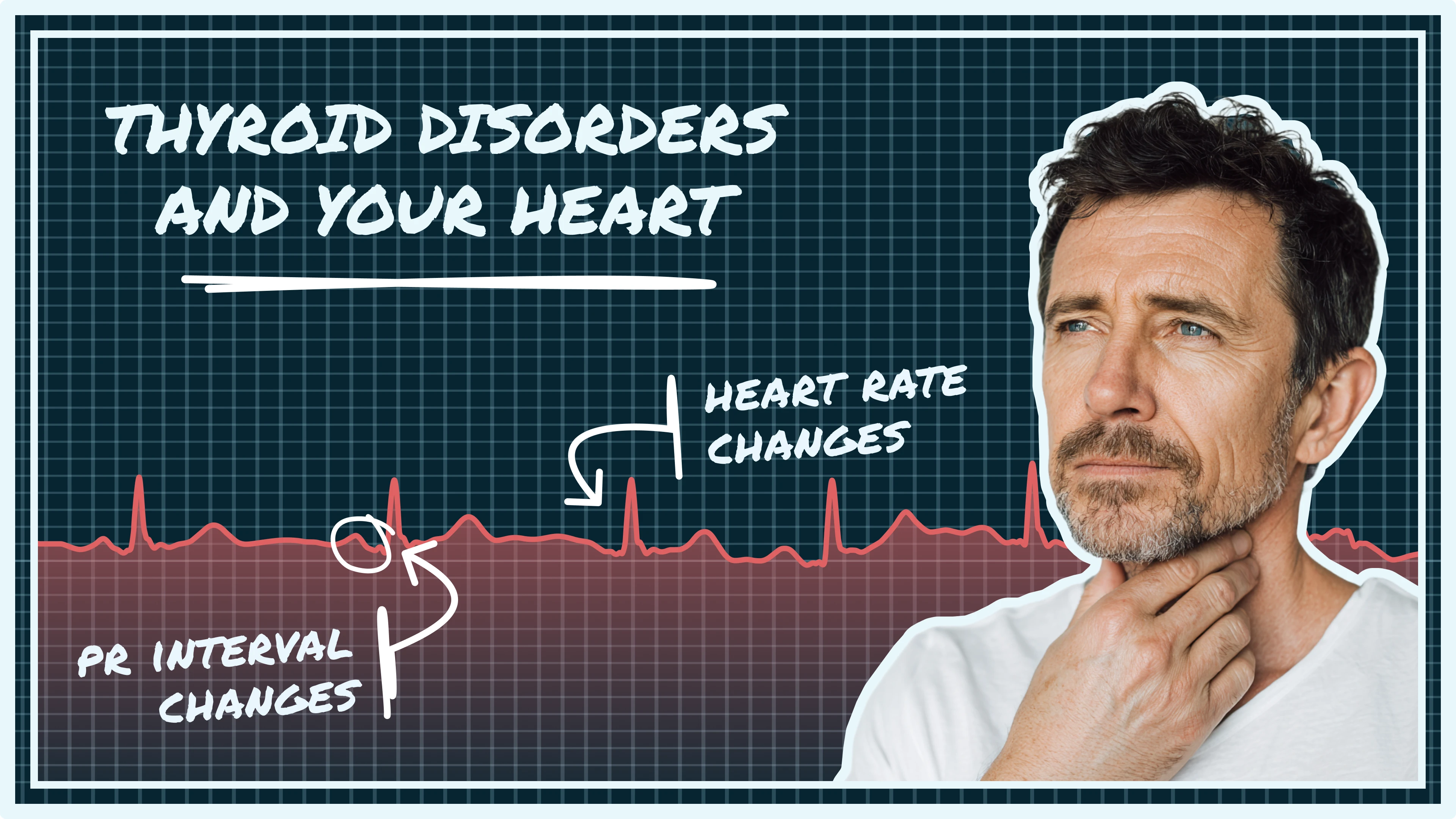 thyroid ECG changes, hyperthyroidism ECG, hypothyroidism ECG, atrial fibrillation thyroid, sinus tachycardia thyroid, bradycardia thyroid, thyroid heart rate, thyroid and heart disease, thyroid hormones heart, ECG thyroid disorders