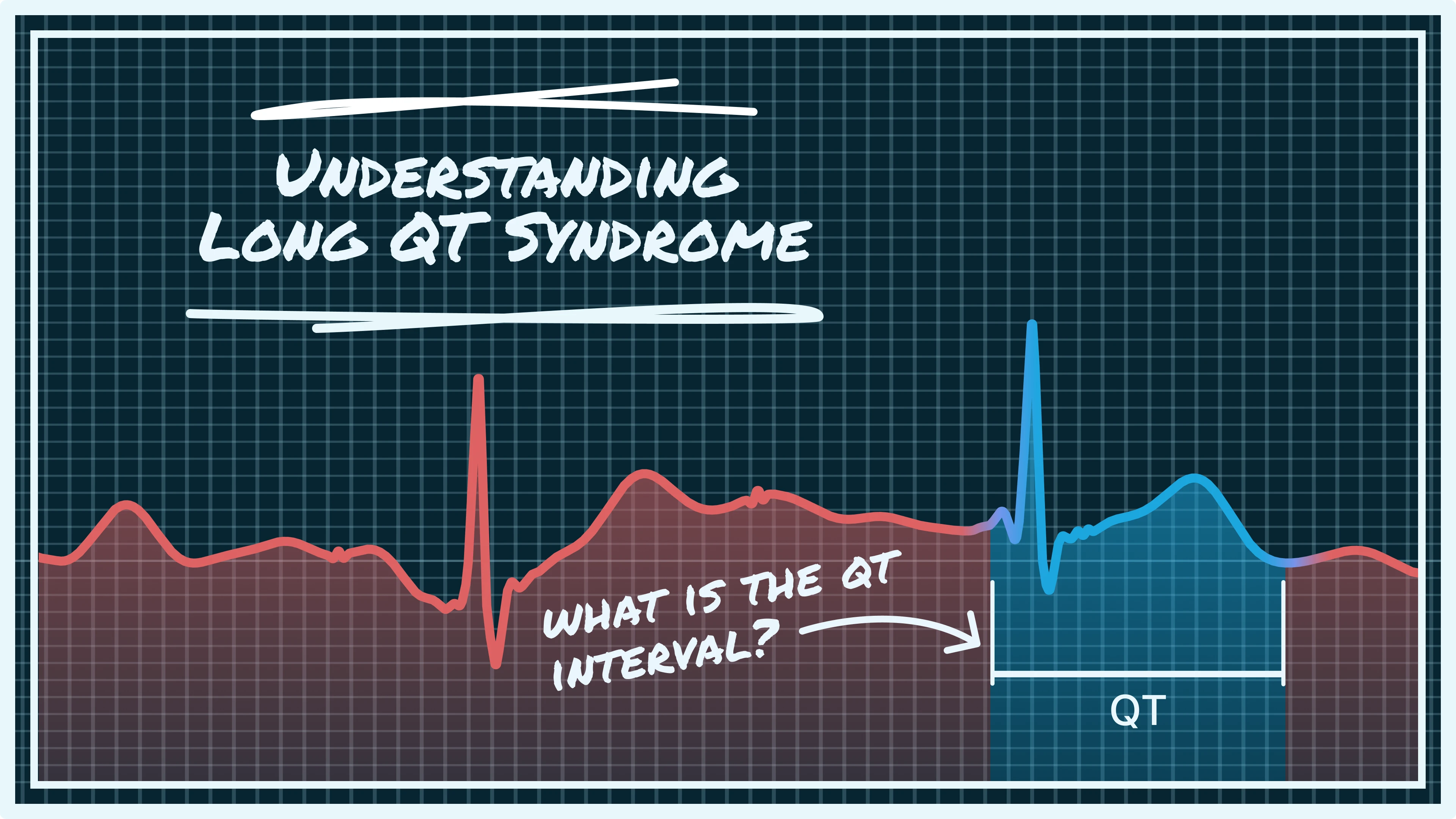 illustration with qt interval, long qt syndrome, qtc vs qt, qt interval, automatic qt