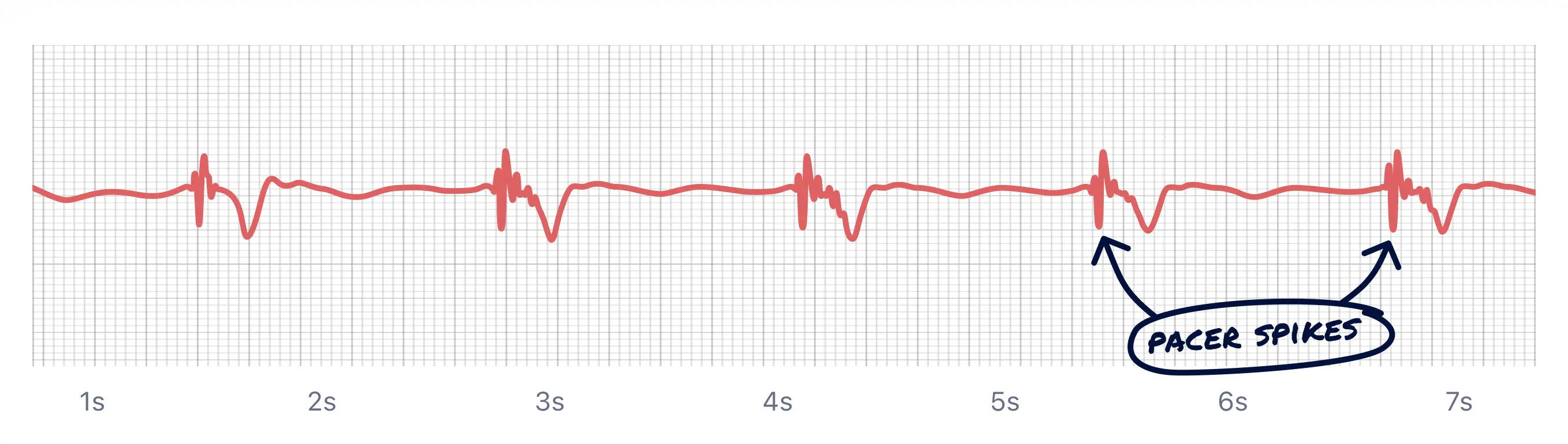 example of pacer spikes on Apple Watch ECG