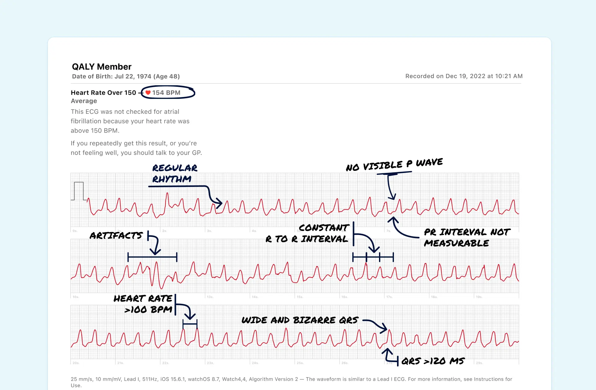 Example of Ventricular Tachycardia (VT) on Apple Watch ECG. Read and reviewed by Qaly team.