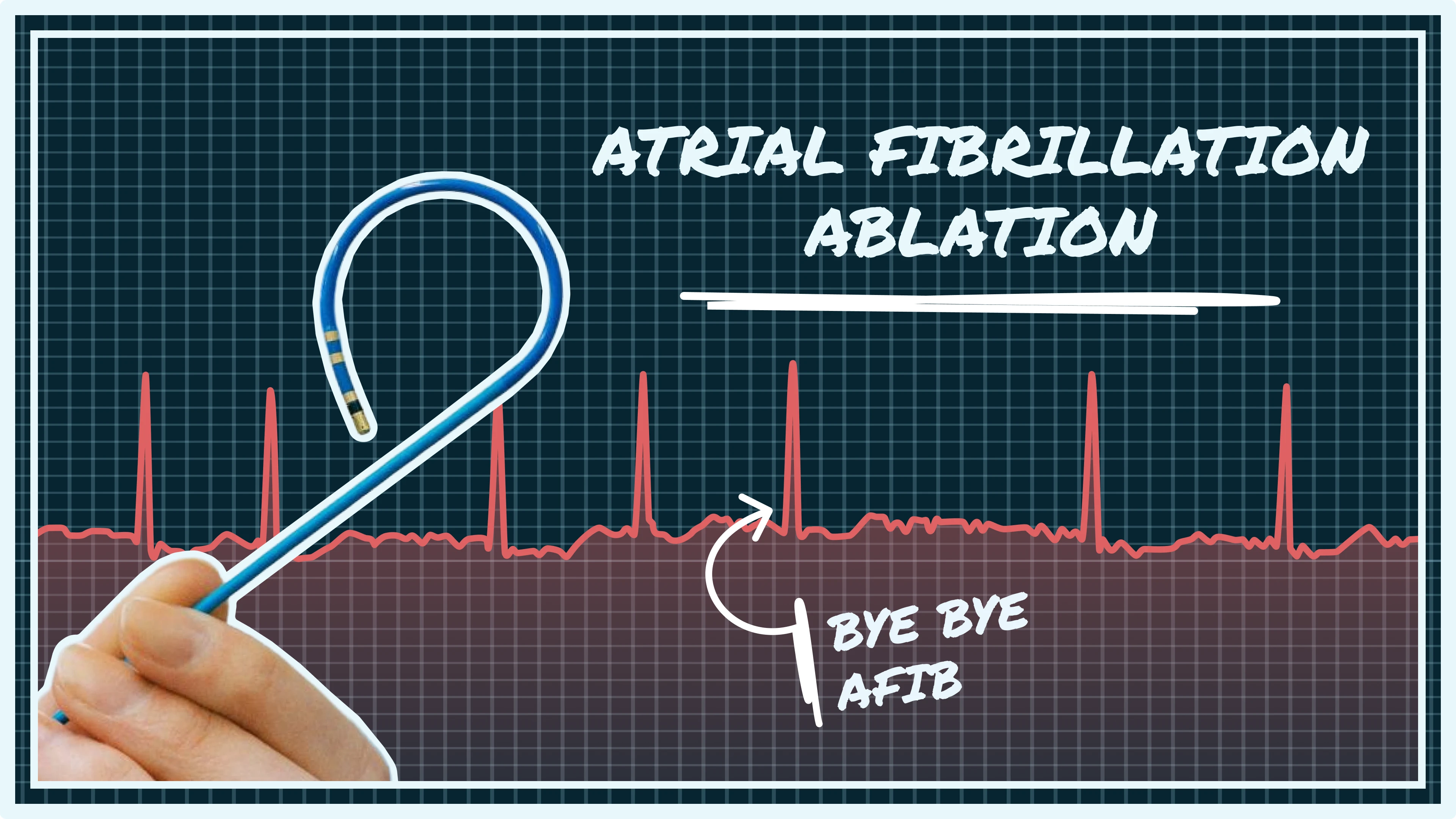afib how to fix, afib ablation, what is afib ablation, afib ablation types