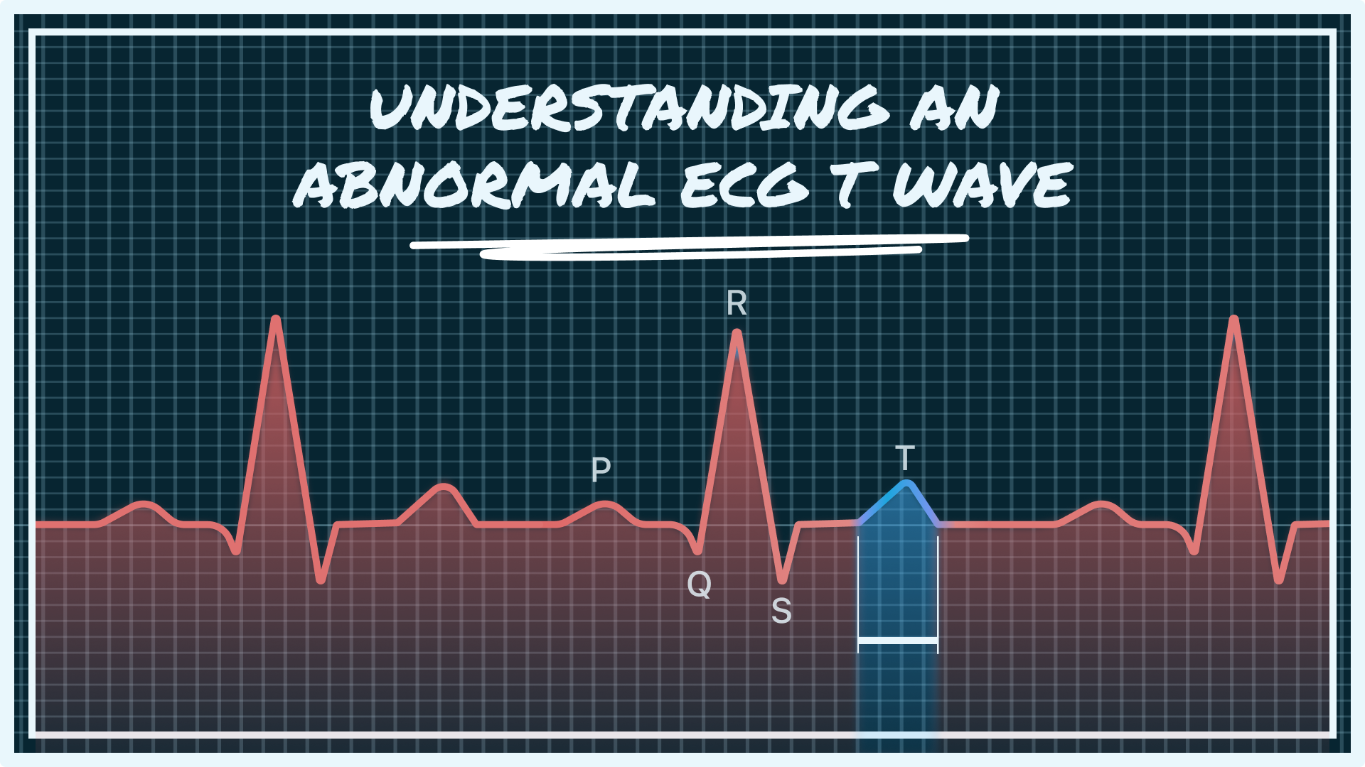Feeling worried about an abnormal ECG T wave? Our clear, reassuring guide explains what it means, the common causes, and what to discuss with your doctor.