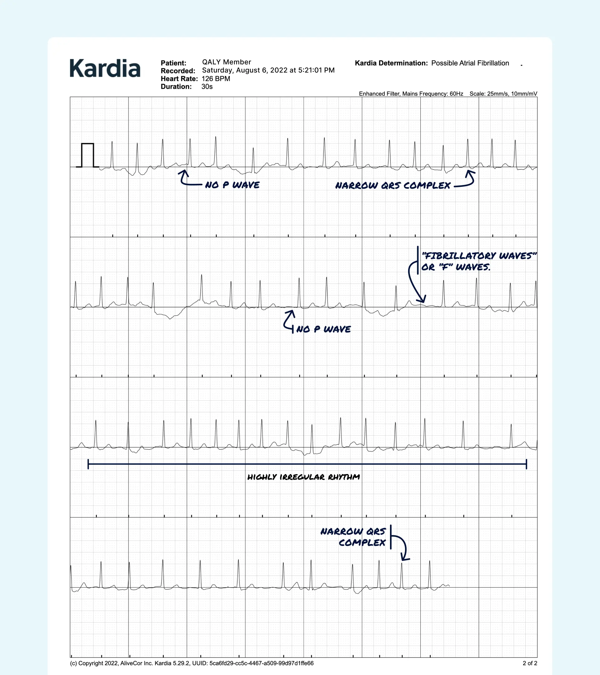 Afib read on a Kardia ECG through the Qaly app.