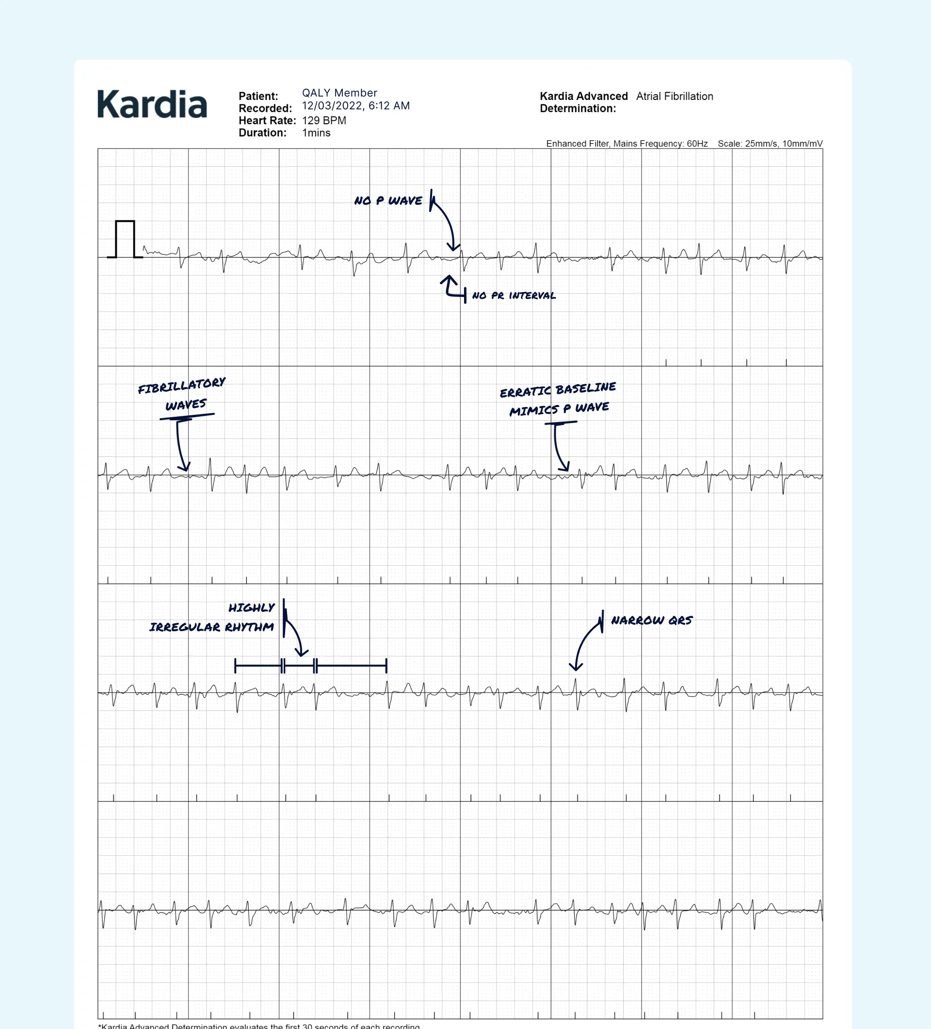 Afib read on a Kardia ECG through the Qaly app.