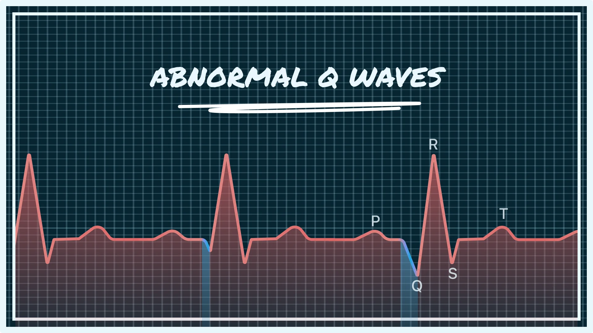 Feeling worried about abnormal Q waves on an ECG? Our guide explains causes, interpretation, and how to take control of your heart health. Get clear answers.