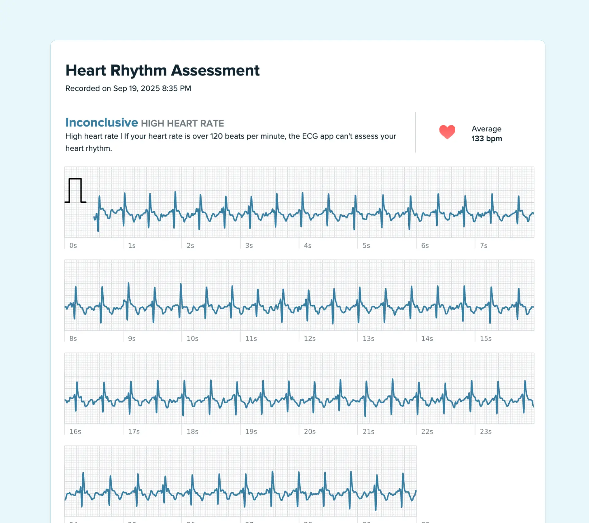 Sinus tachycardia on Fitbit ECG