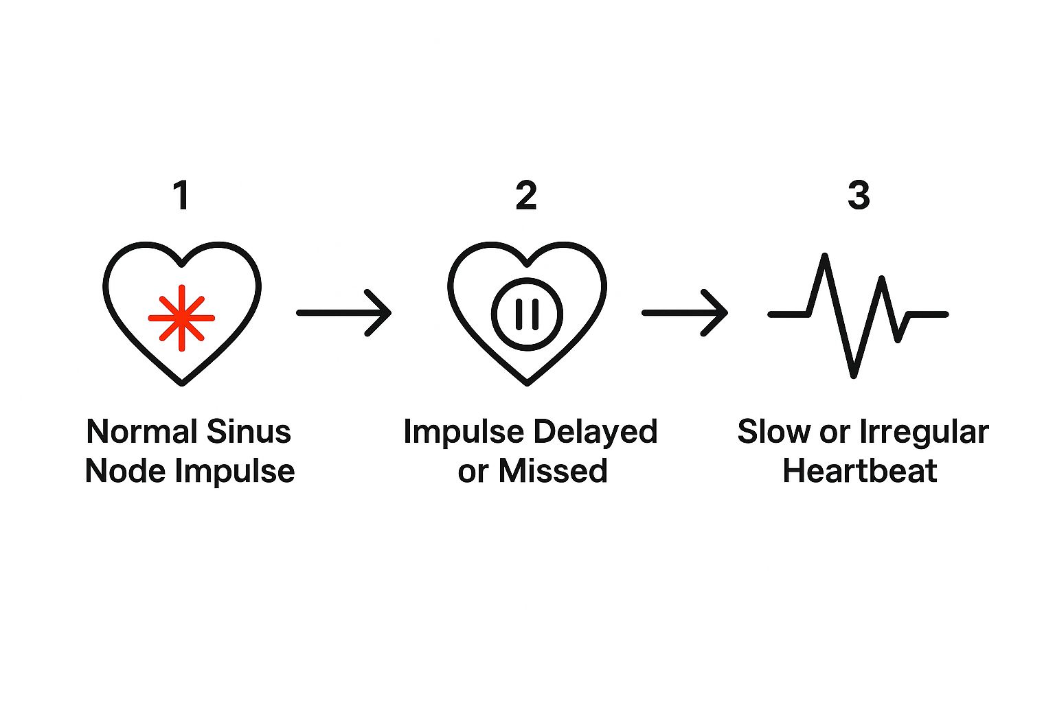 Infographic showing the process of sinus node dysfunction, from a normal impulse to a delayed one, resulting in an irregular heartbeat.