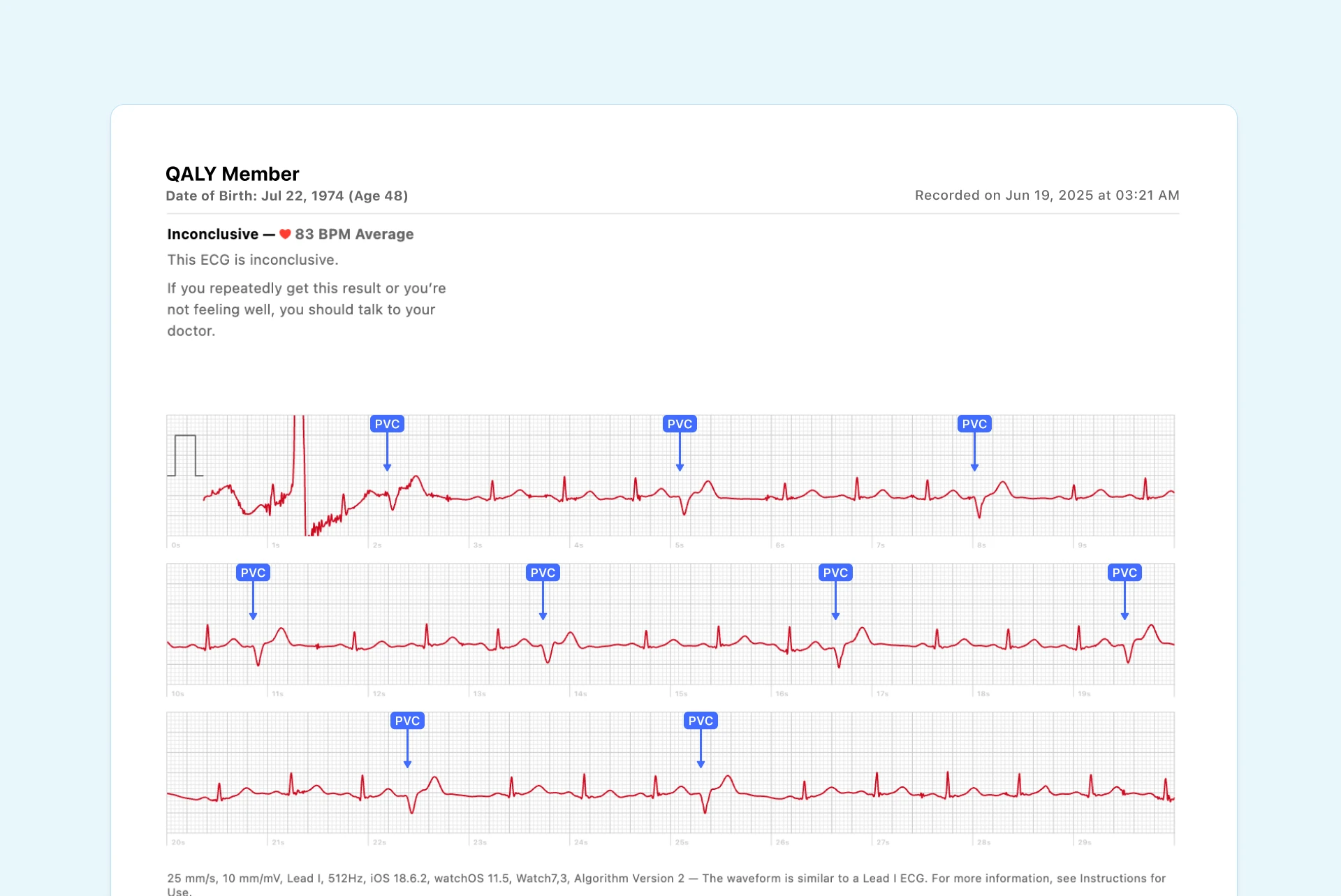 Multiple PVCs on Apple Watch ECG