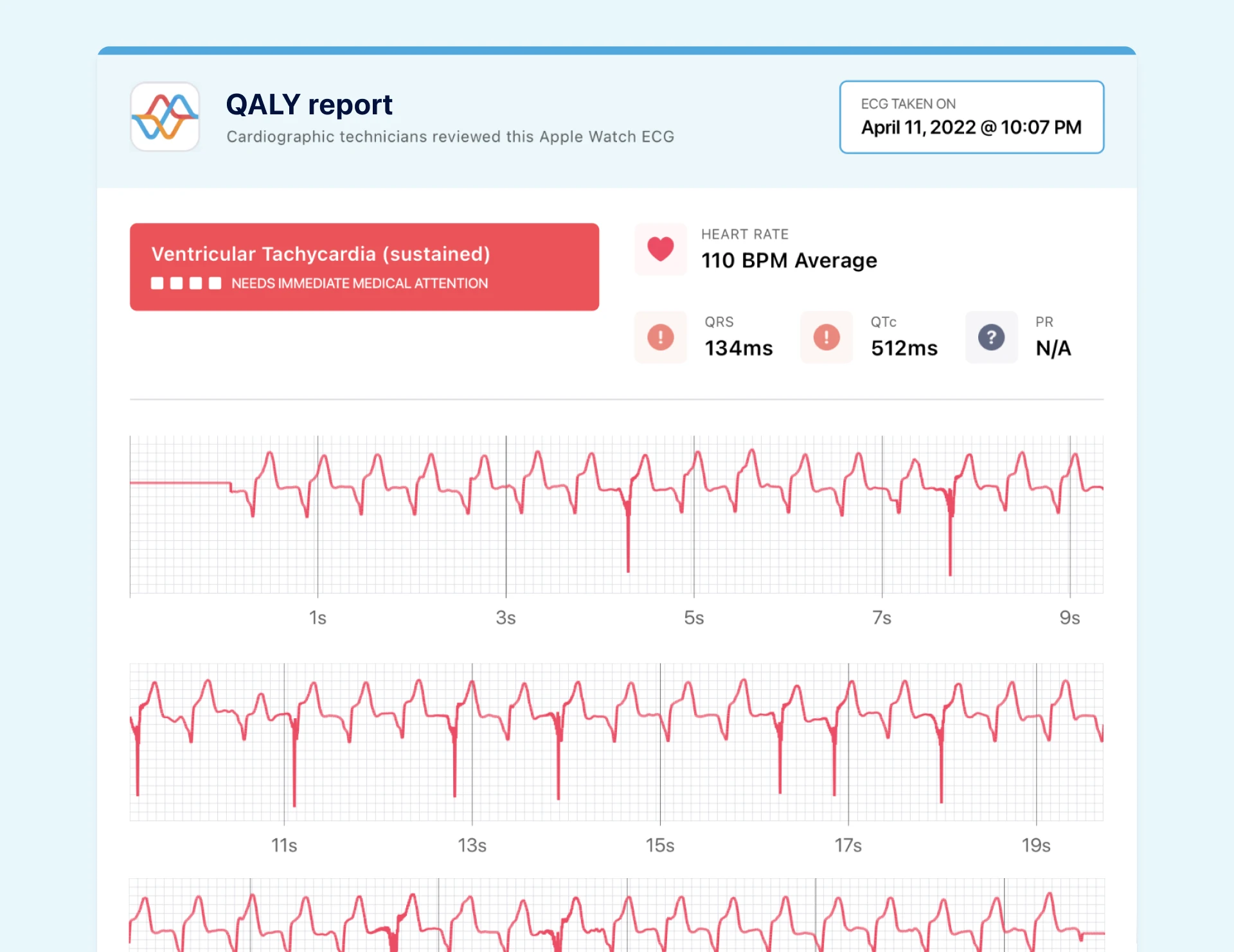 Example of ECG with abnormal QTc interval