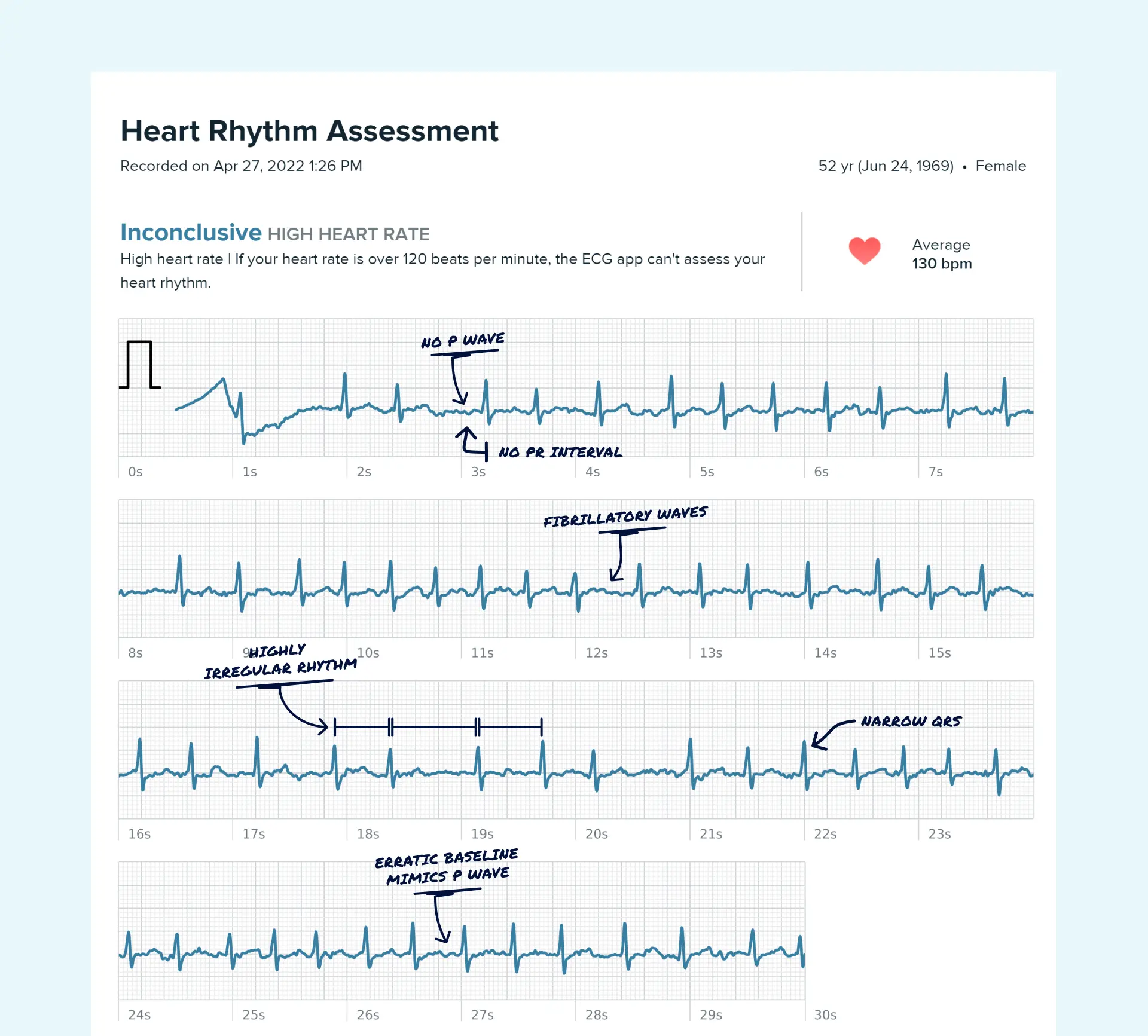 Afib read on a Fitbit ECG through the Qaly app.