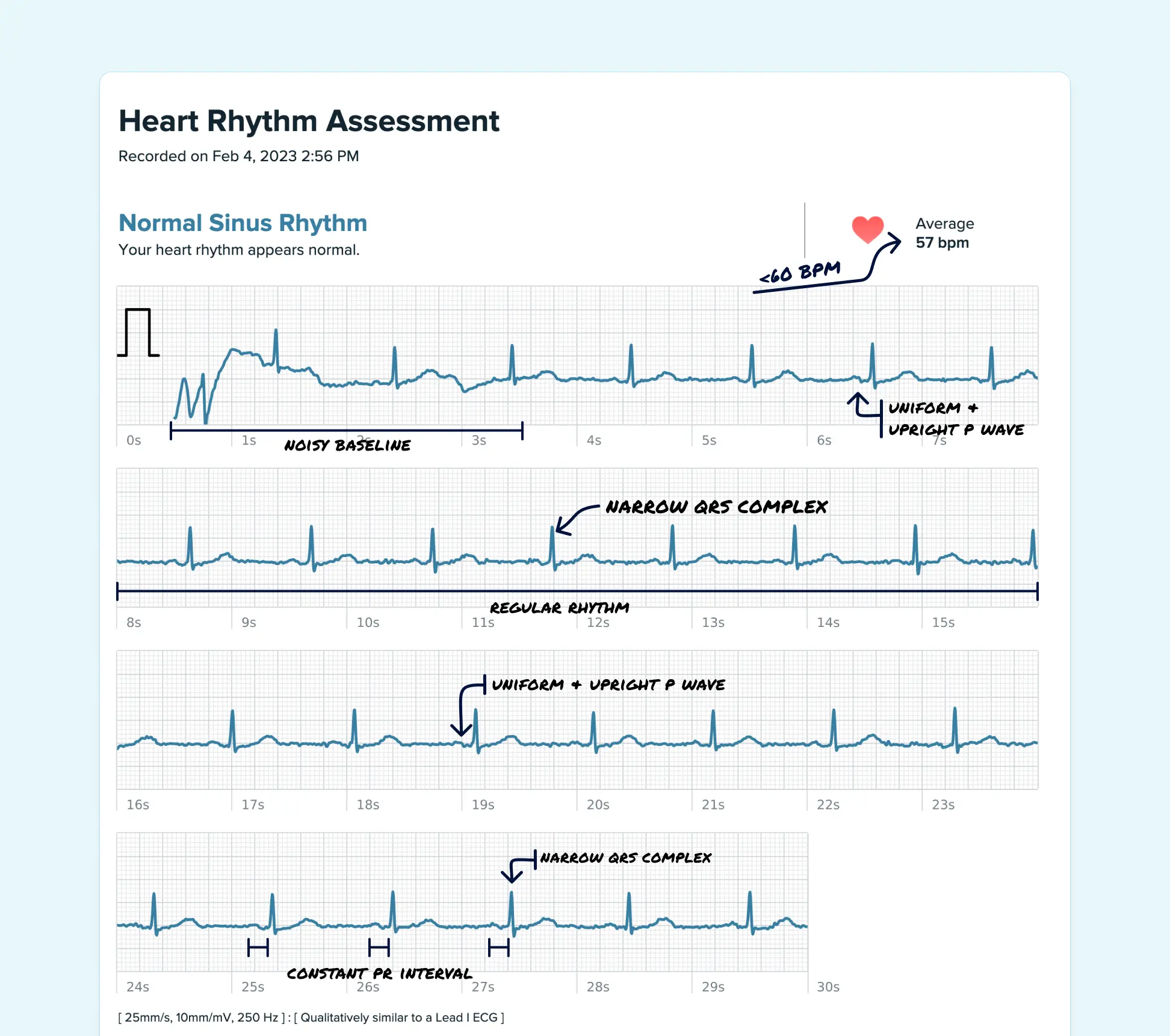Sinus Bradycardia read on a Fitbit ECG through the Qaly app.