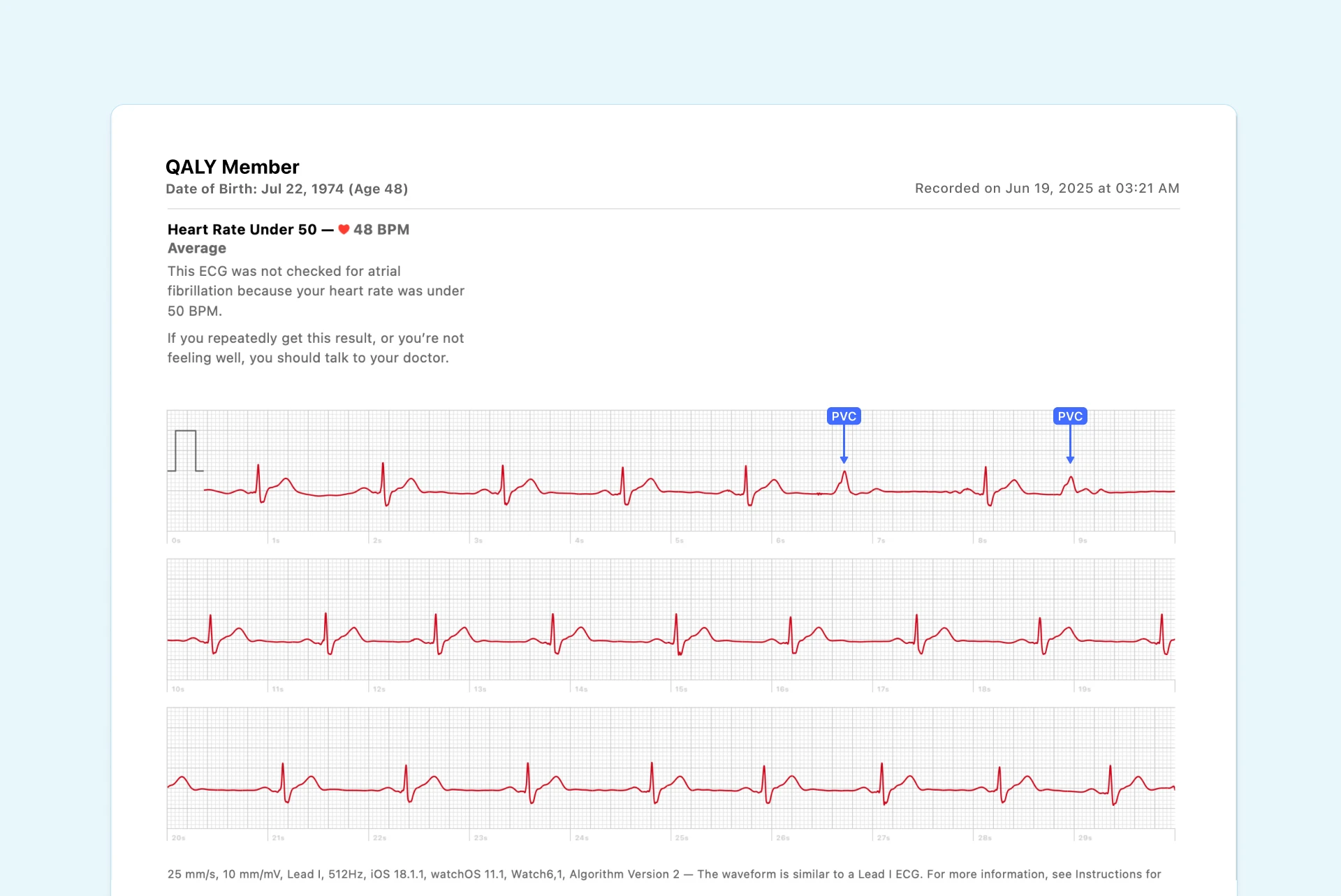 bradycardia on Apple Watch ecg