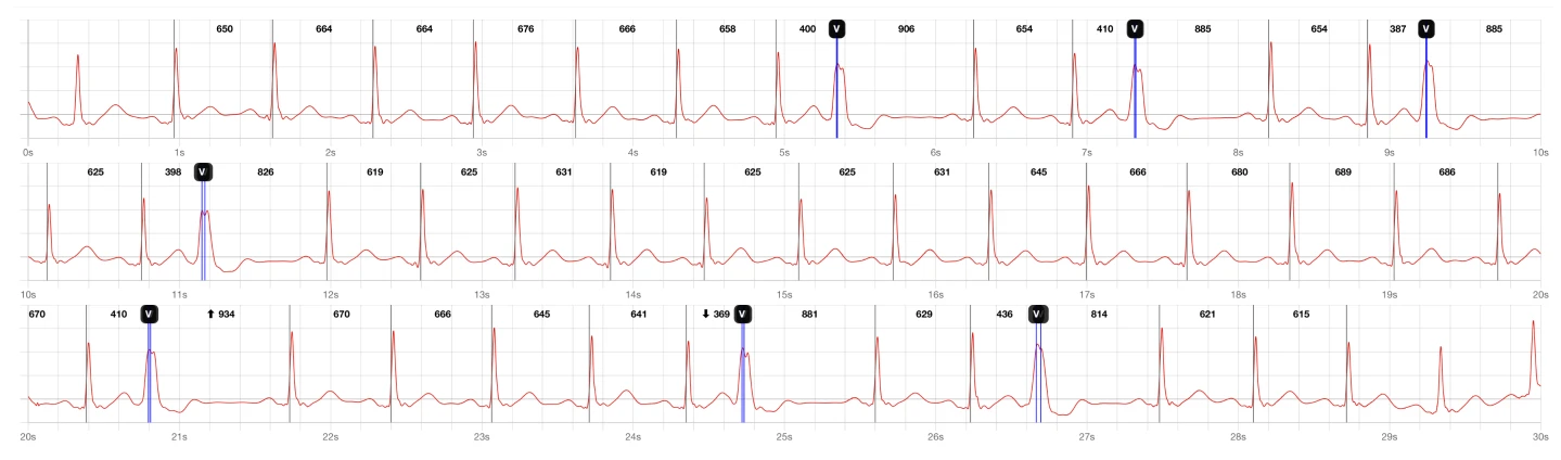rr intervals on ecg