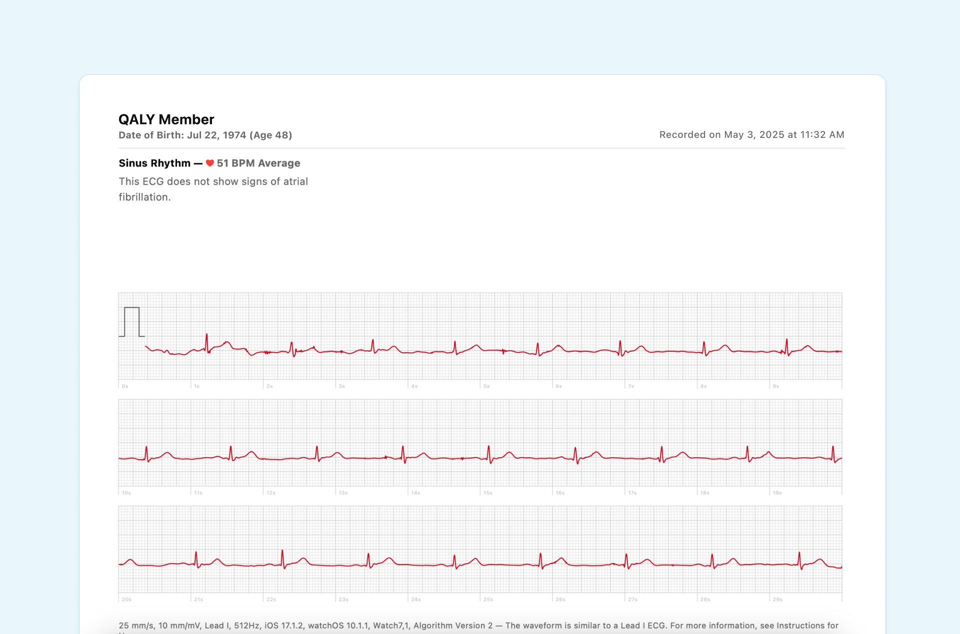 sinus bradycardia example apple watch