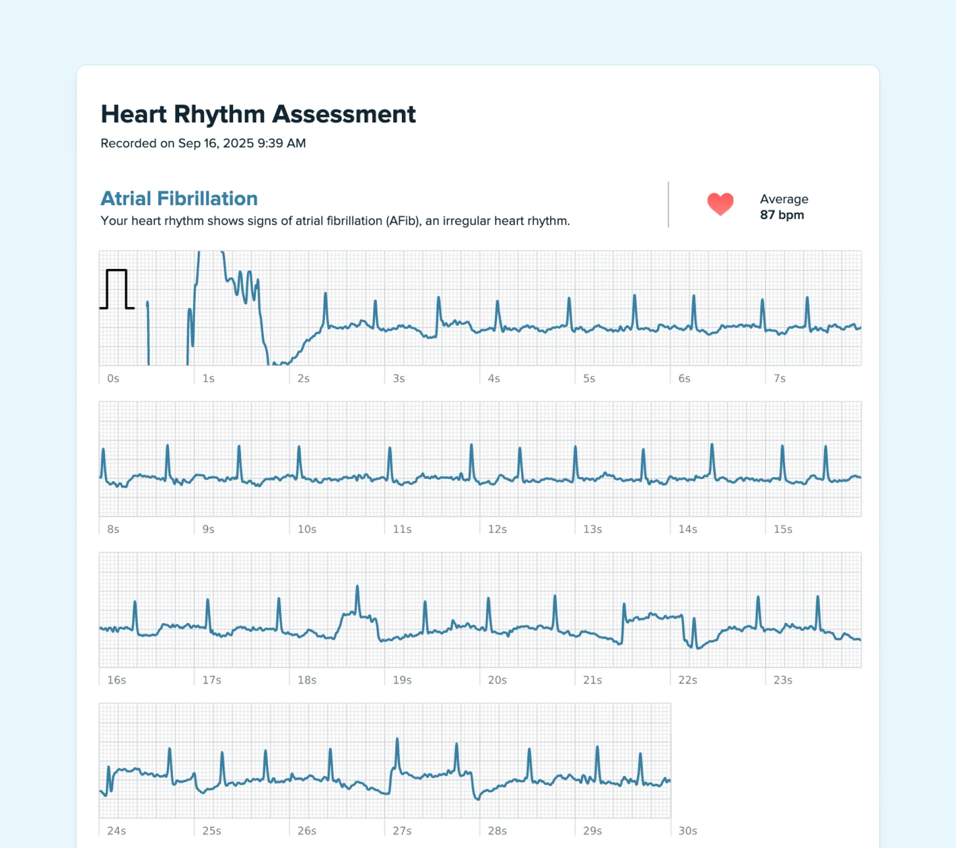 Example of Atrial Fibrillation on a Fitbit watch