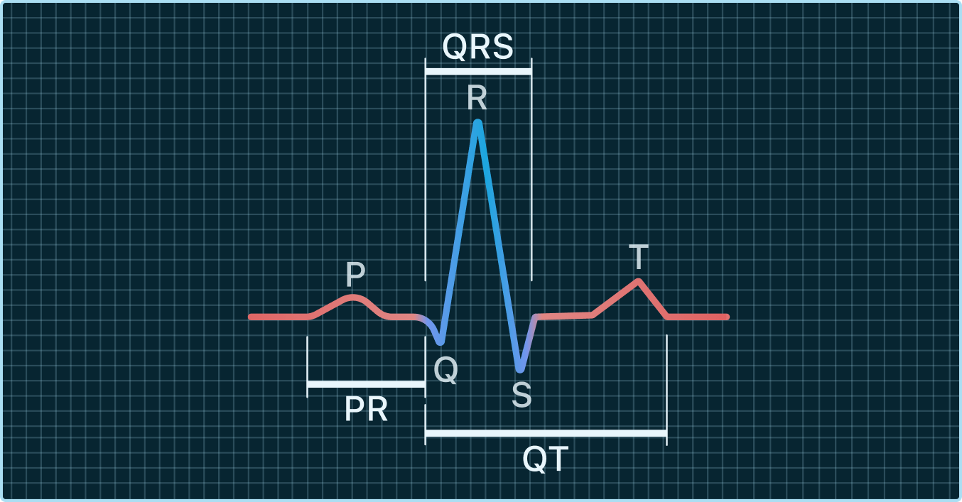 Your QRS Interval, in blue.