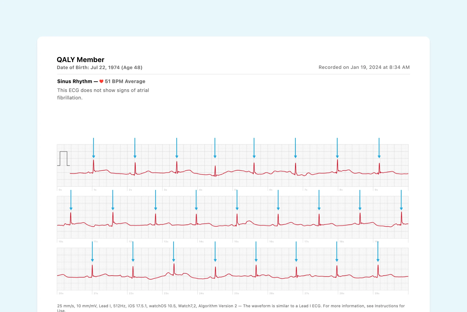 R peaks in Apple Watch ECG