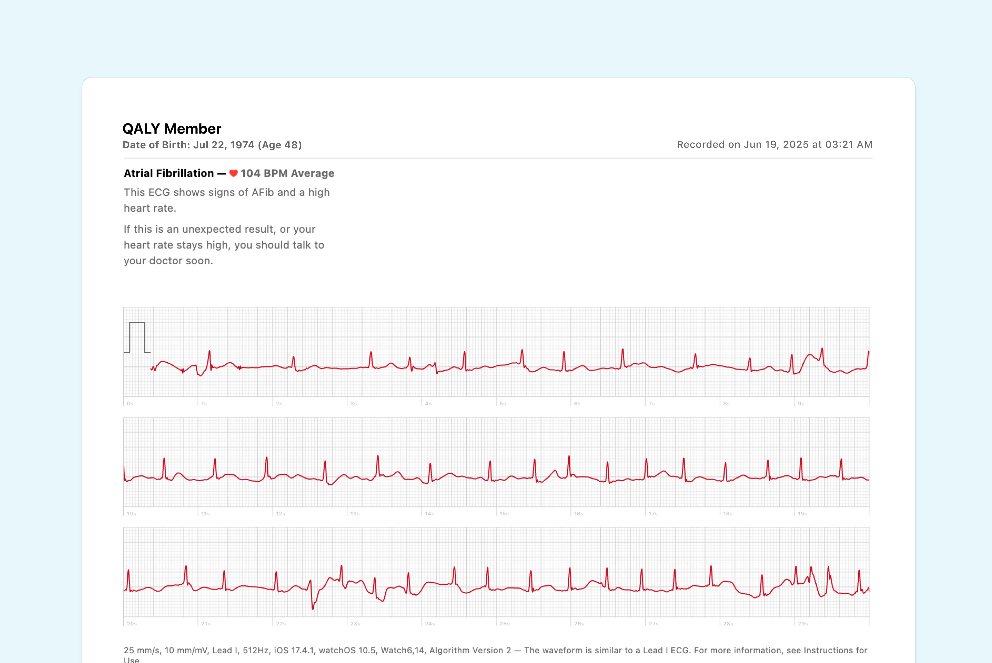 Example of Atrial Fibrillation (AFib) on an Apple Watch