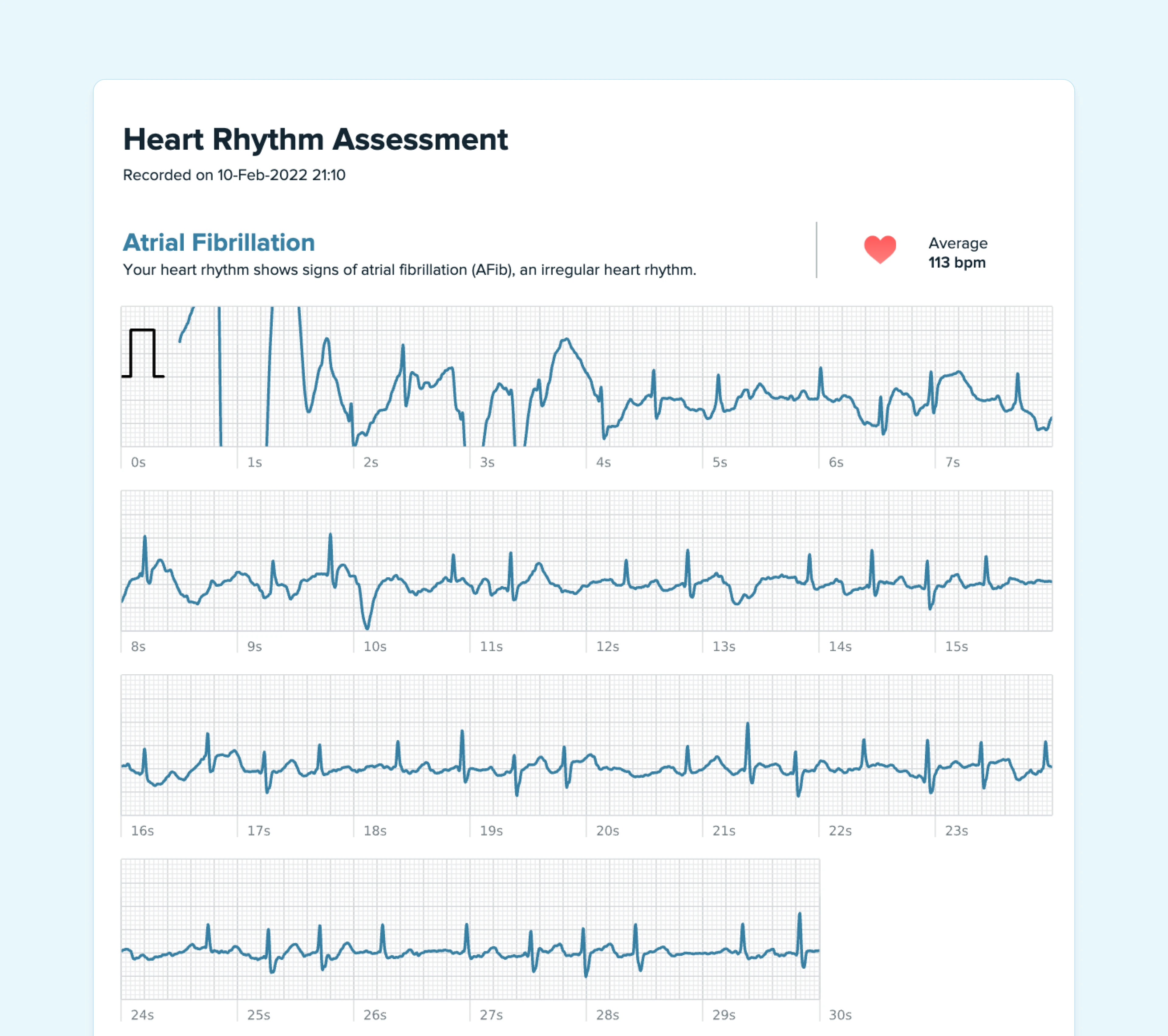 Example of Atrial Fibrillation (AFib) on Fitbit ECG