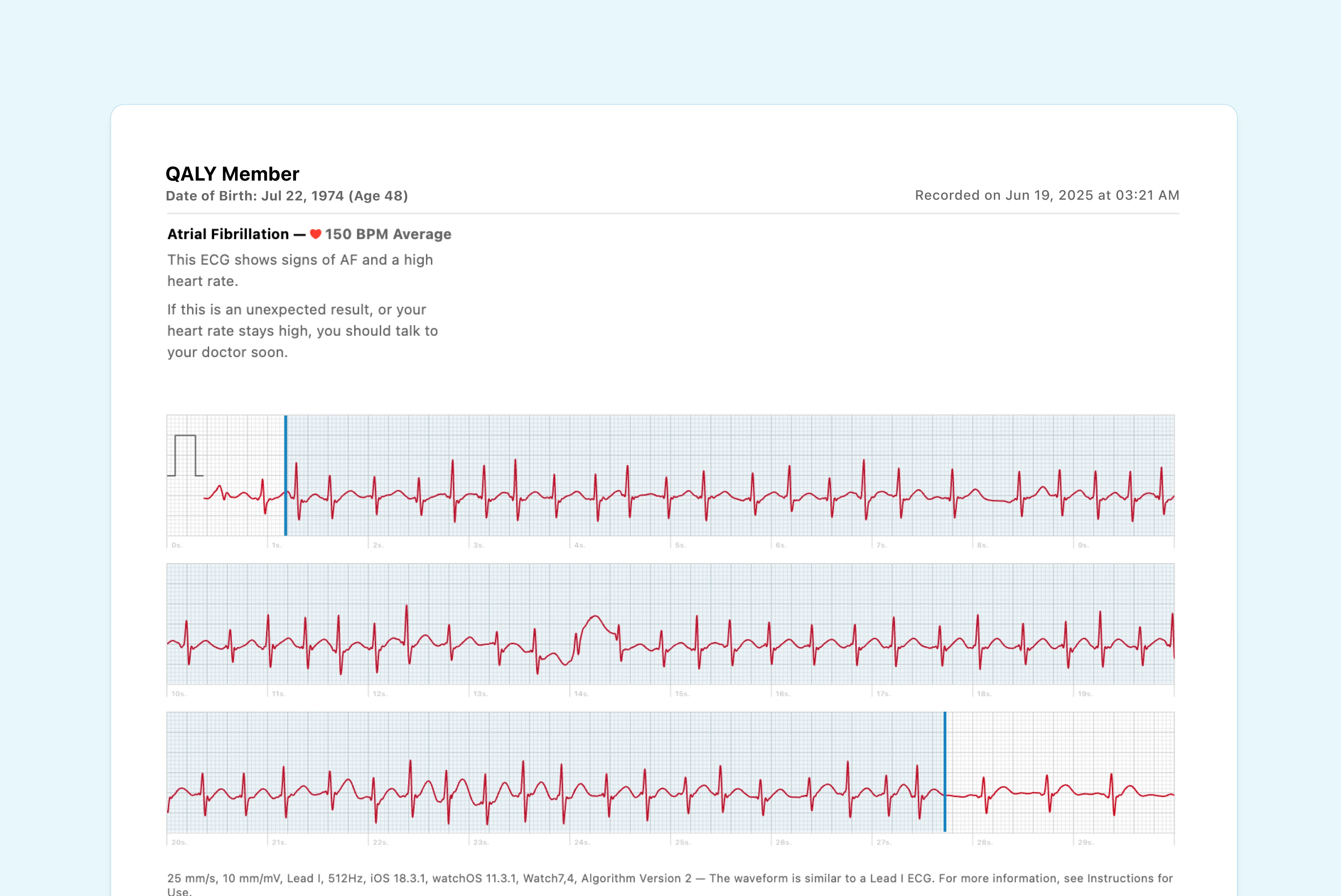 Example of Supraventricular Tachycardia (SVT) on Apple Watch ECG. Notice that the watch mistakenly marks it as AFib.