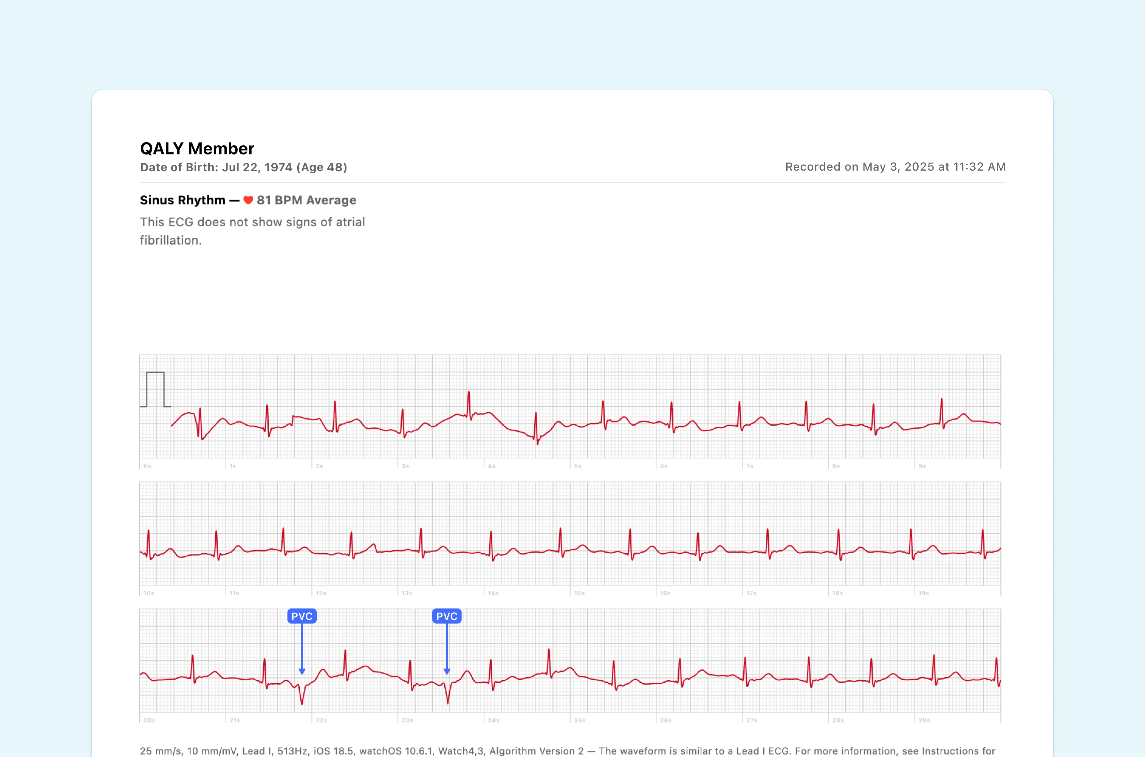 Examples of Premature Ventricular Contractions (PVCs) on Apple Watch ECG