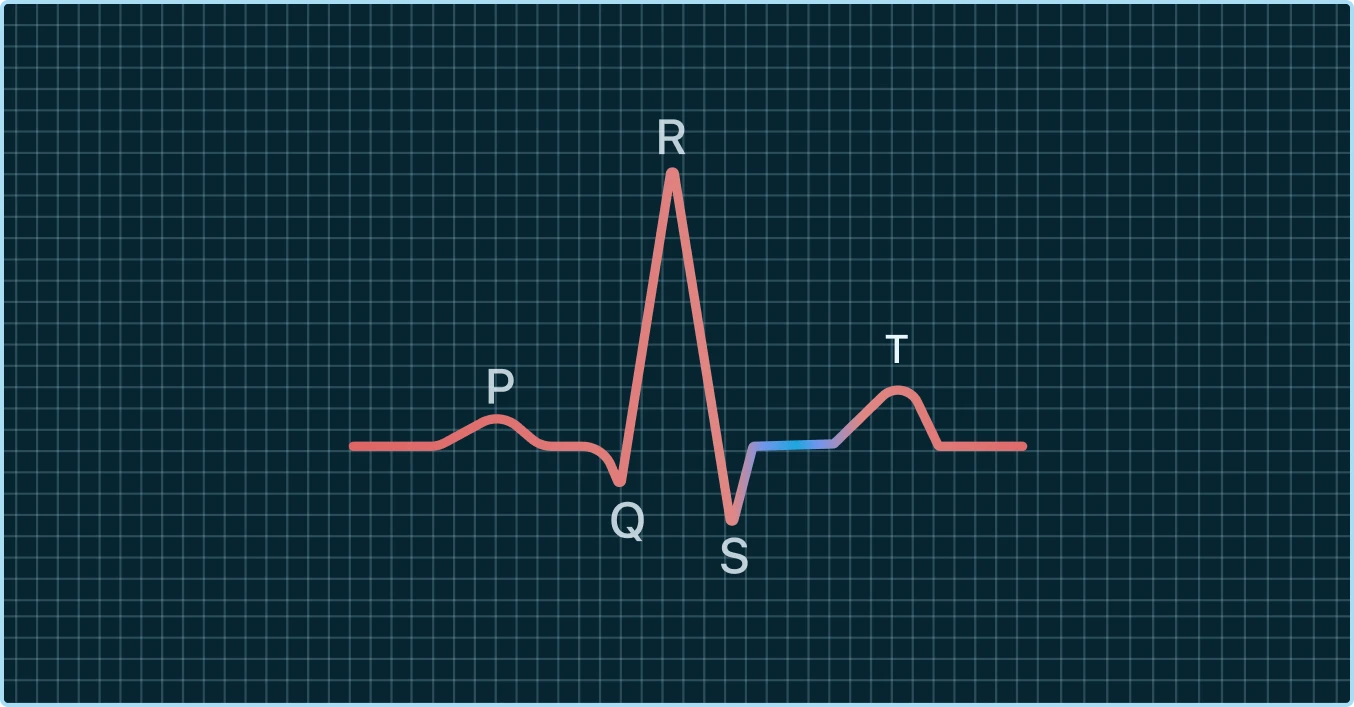 Horizontal ST Depression