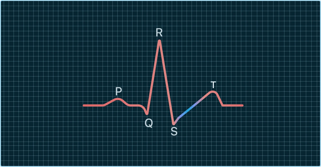 Upsloping ST Depression