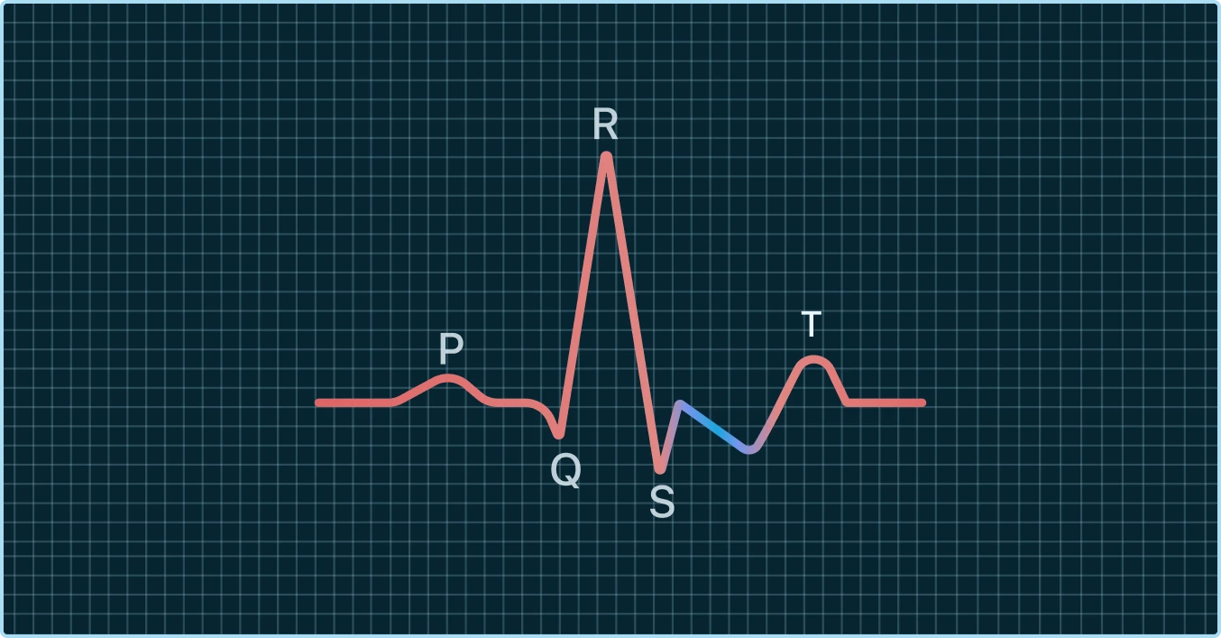 Downsloping ST Depression