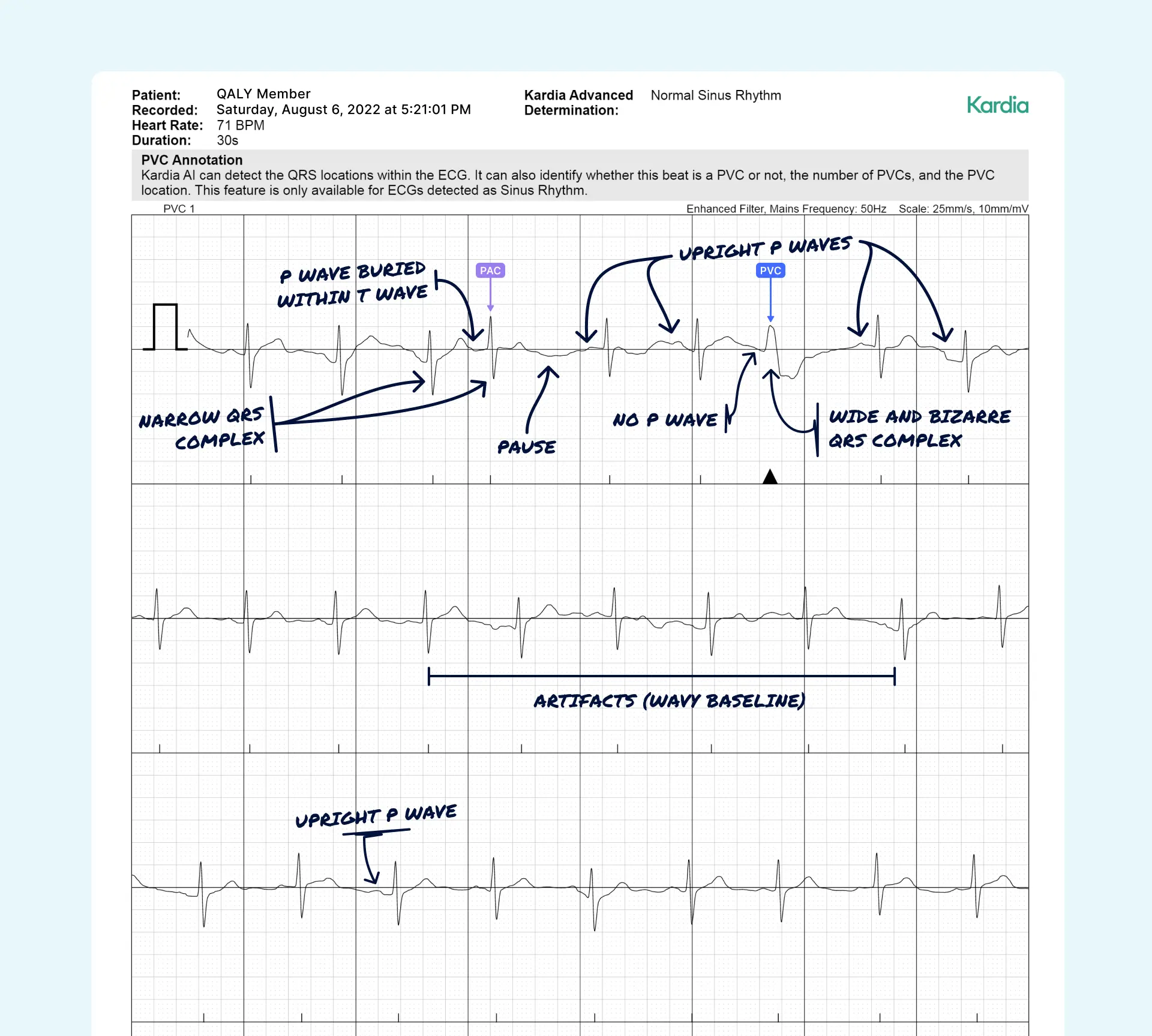 PAC and PVC read on a Kardia ECG through the Qaly app.