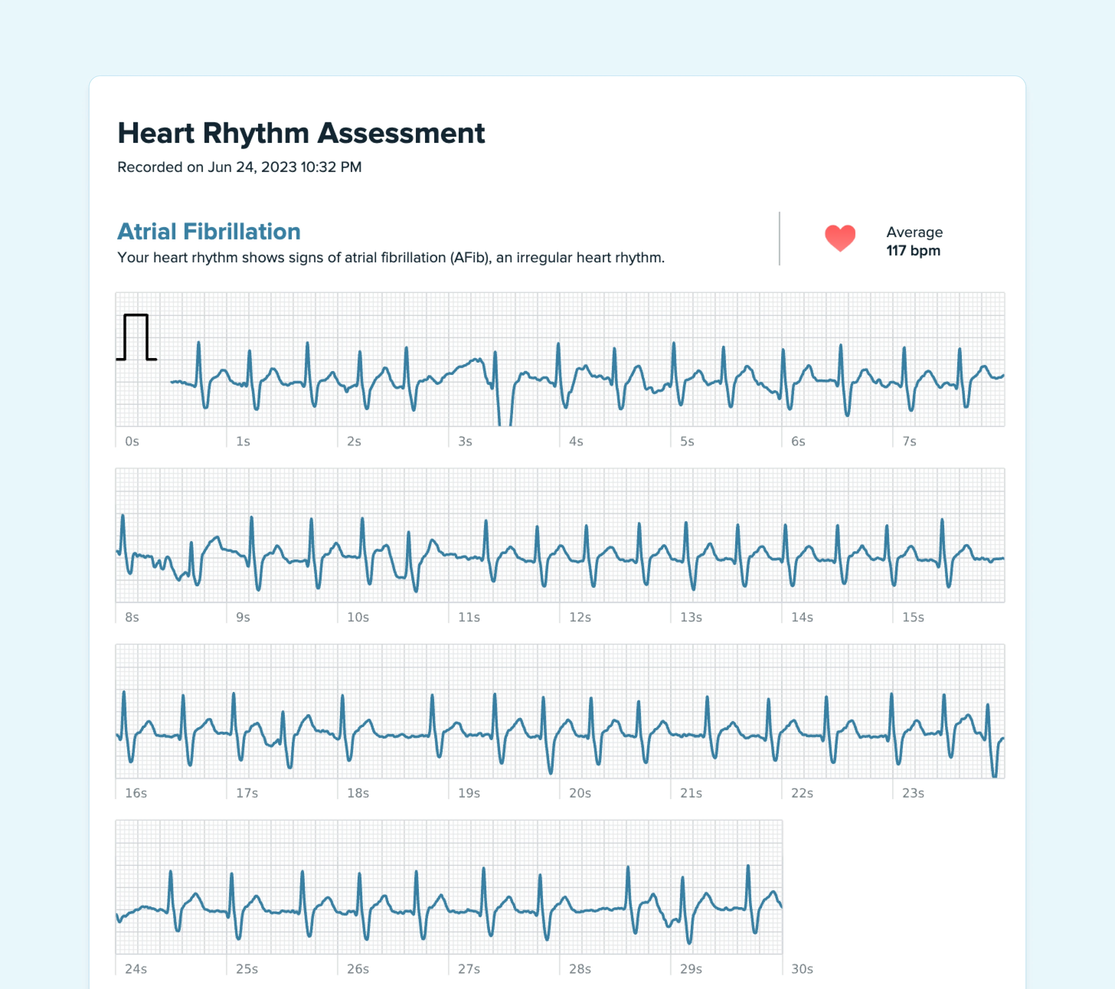 Example of Atrial Fibrillation (AFib) on a Fitbit watch.