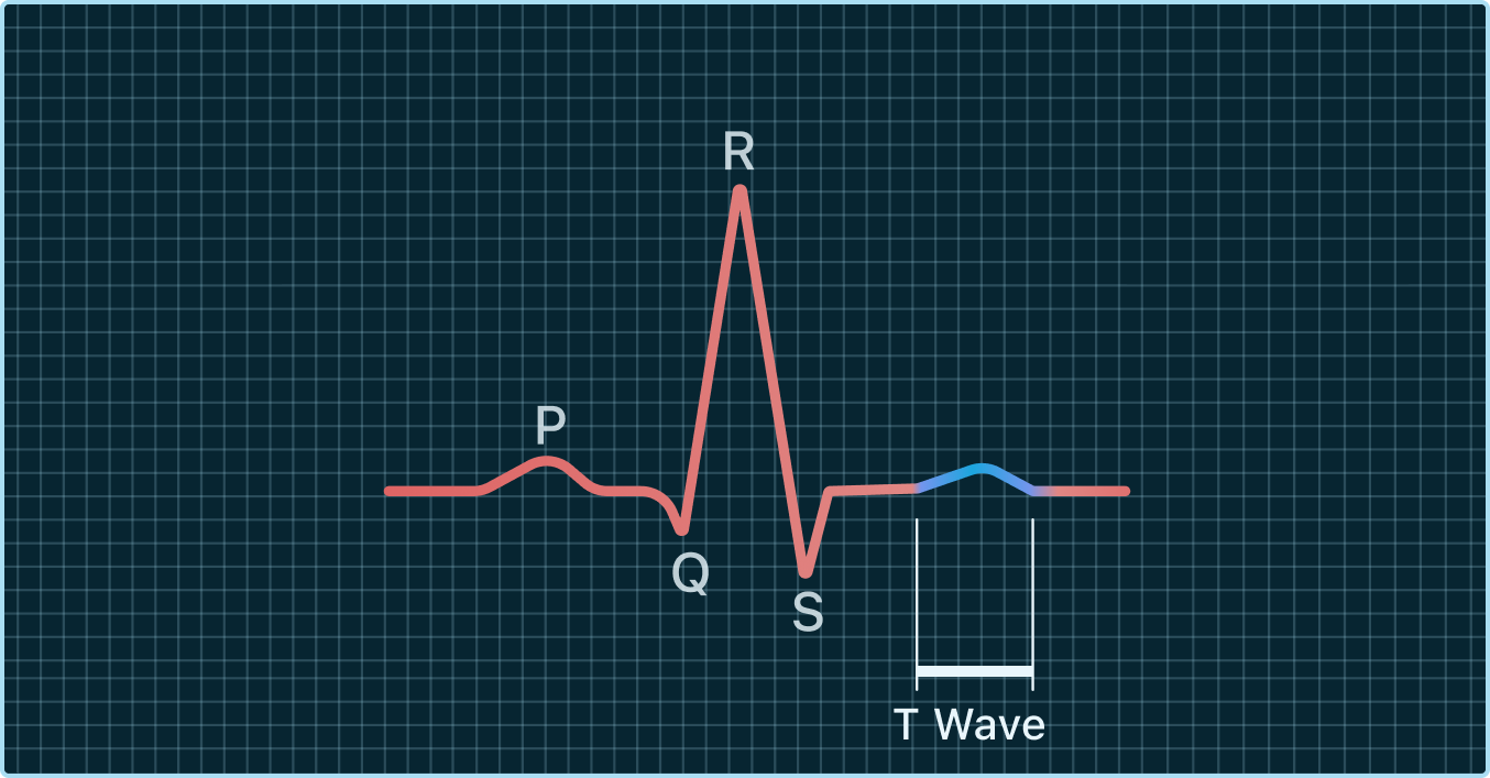 falttened t wave on ecg