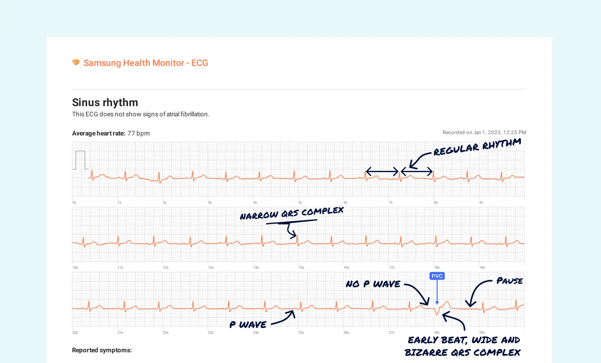 PVC read on a Samsung Watch ECG through the Qaly app.