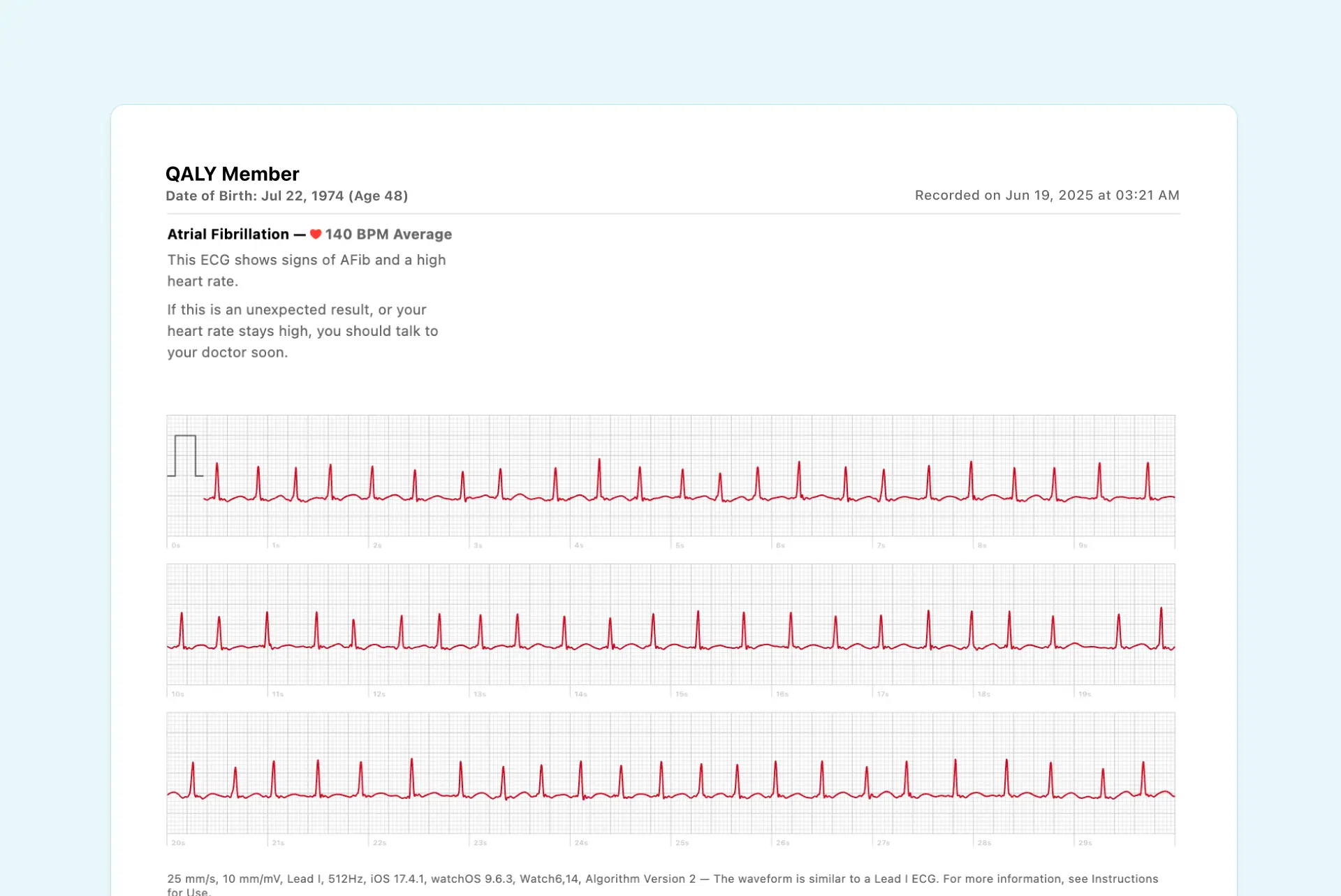 Example of Atrial Fibrillation (AFib) on Apple Watch ECG