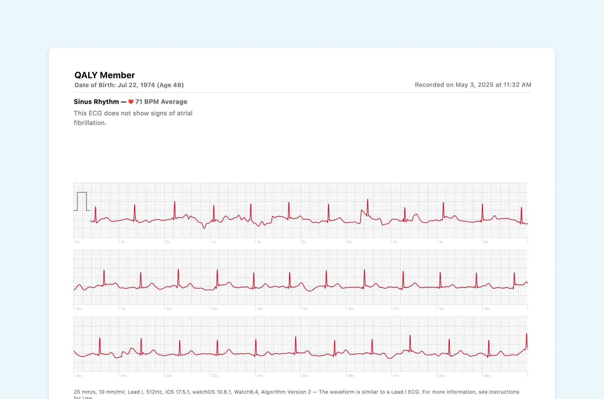 Example of Sinus Rhythm from Apple Watch ECG