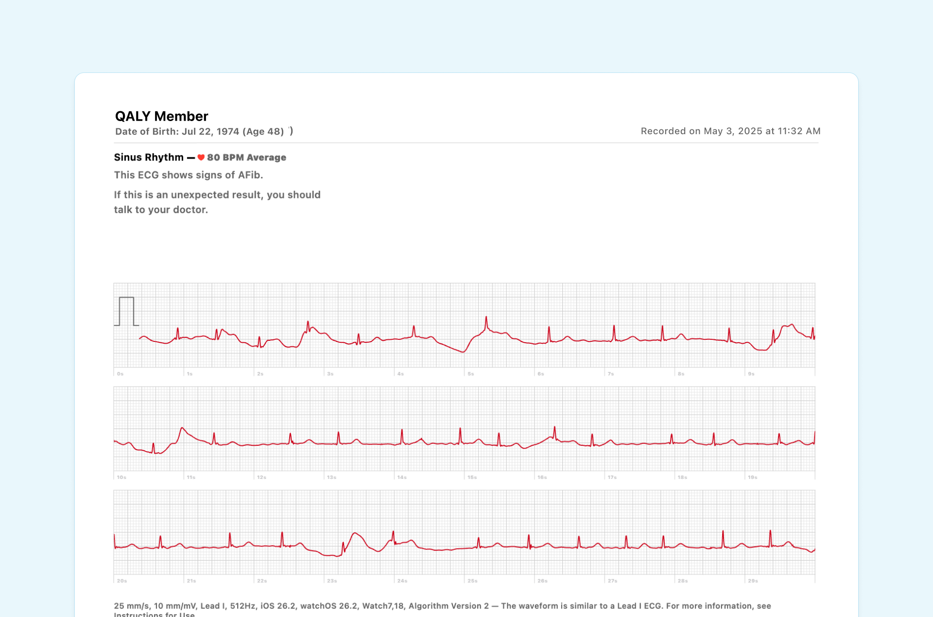 Example of Atrial Fibrillation on Apple Watch