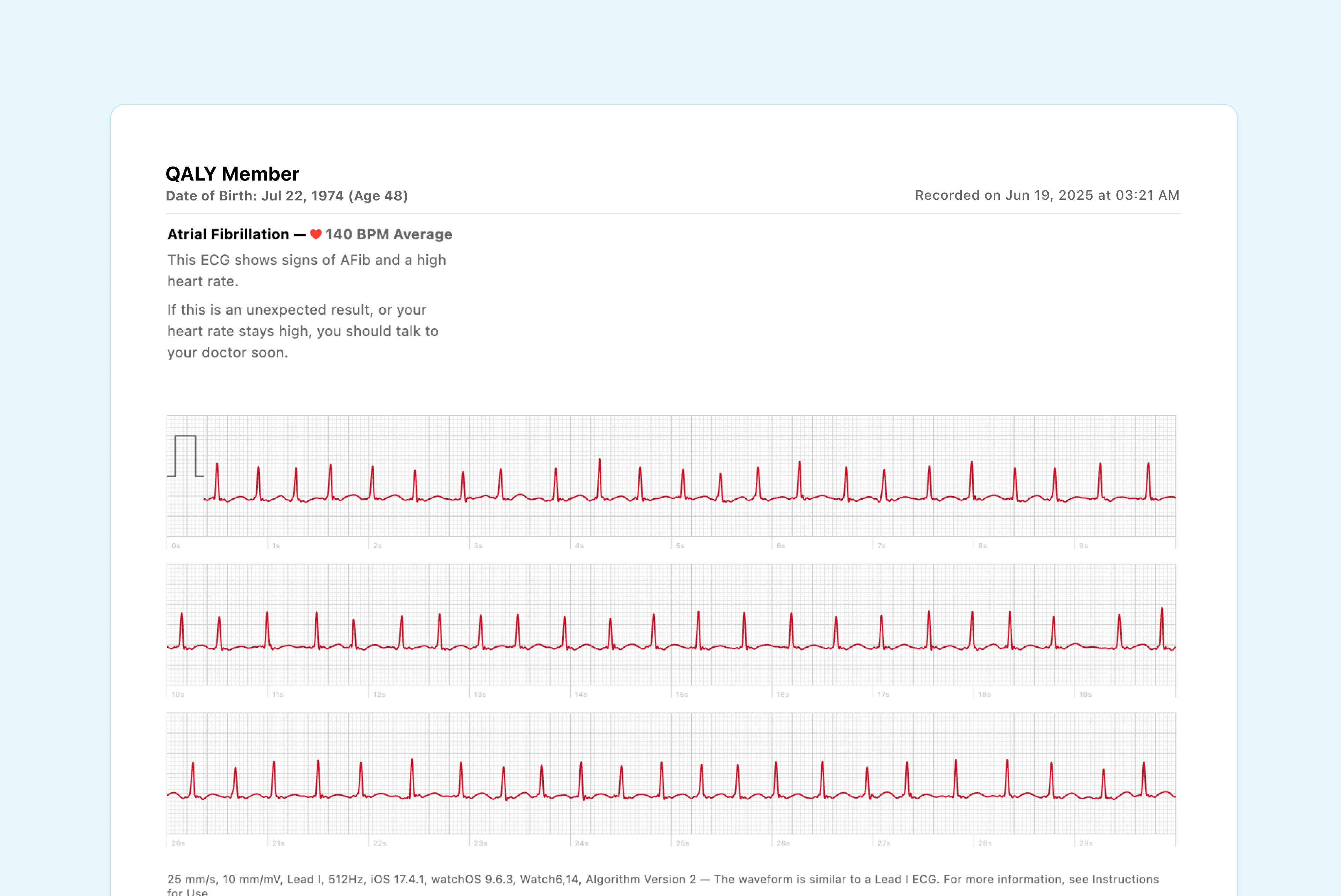 Example of Apple Watch ECG with Atrial Fibrillation